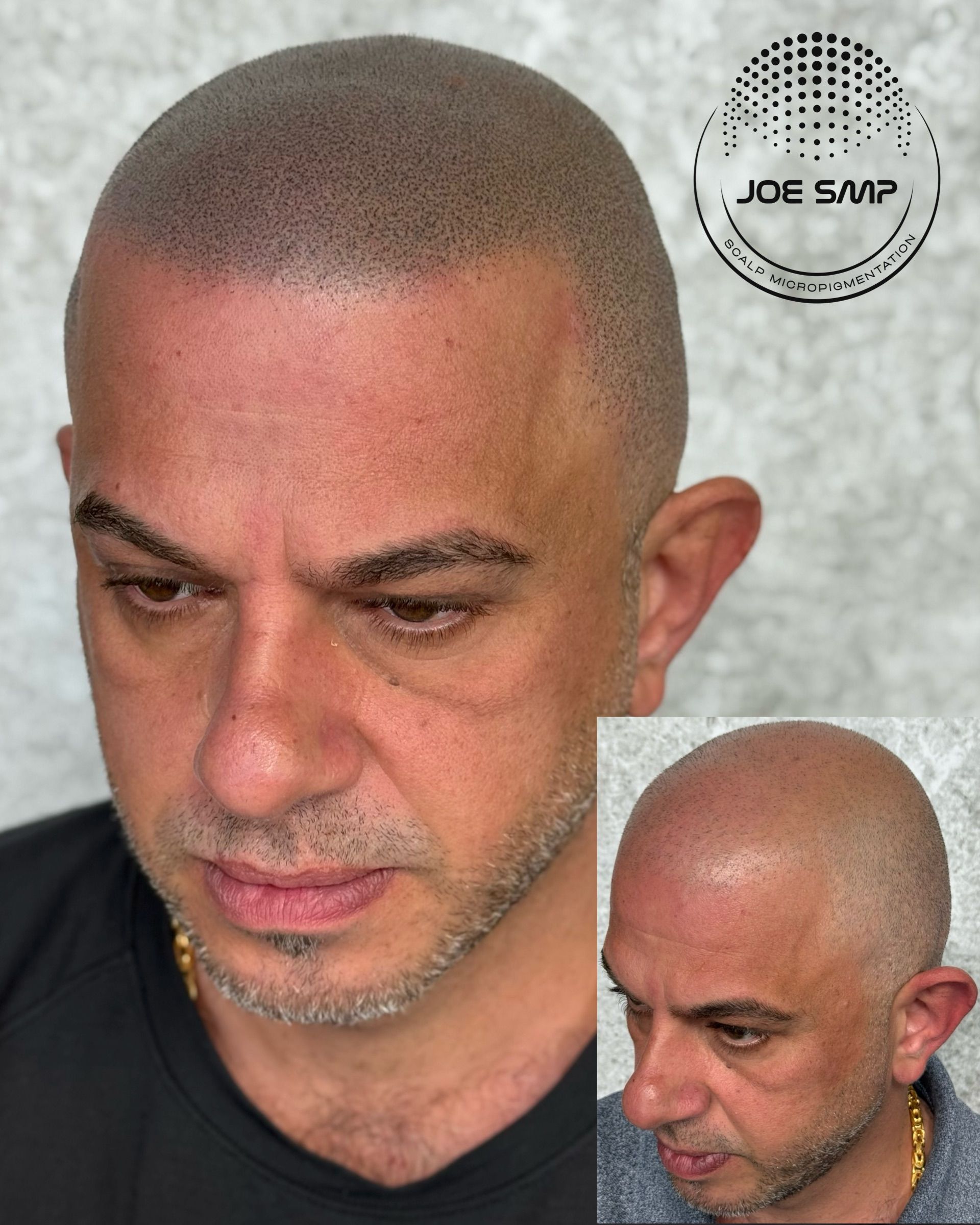 Man with scalp micropigmentation, showcasing before-and-after results. Dark dots simulate hair.