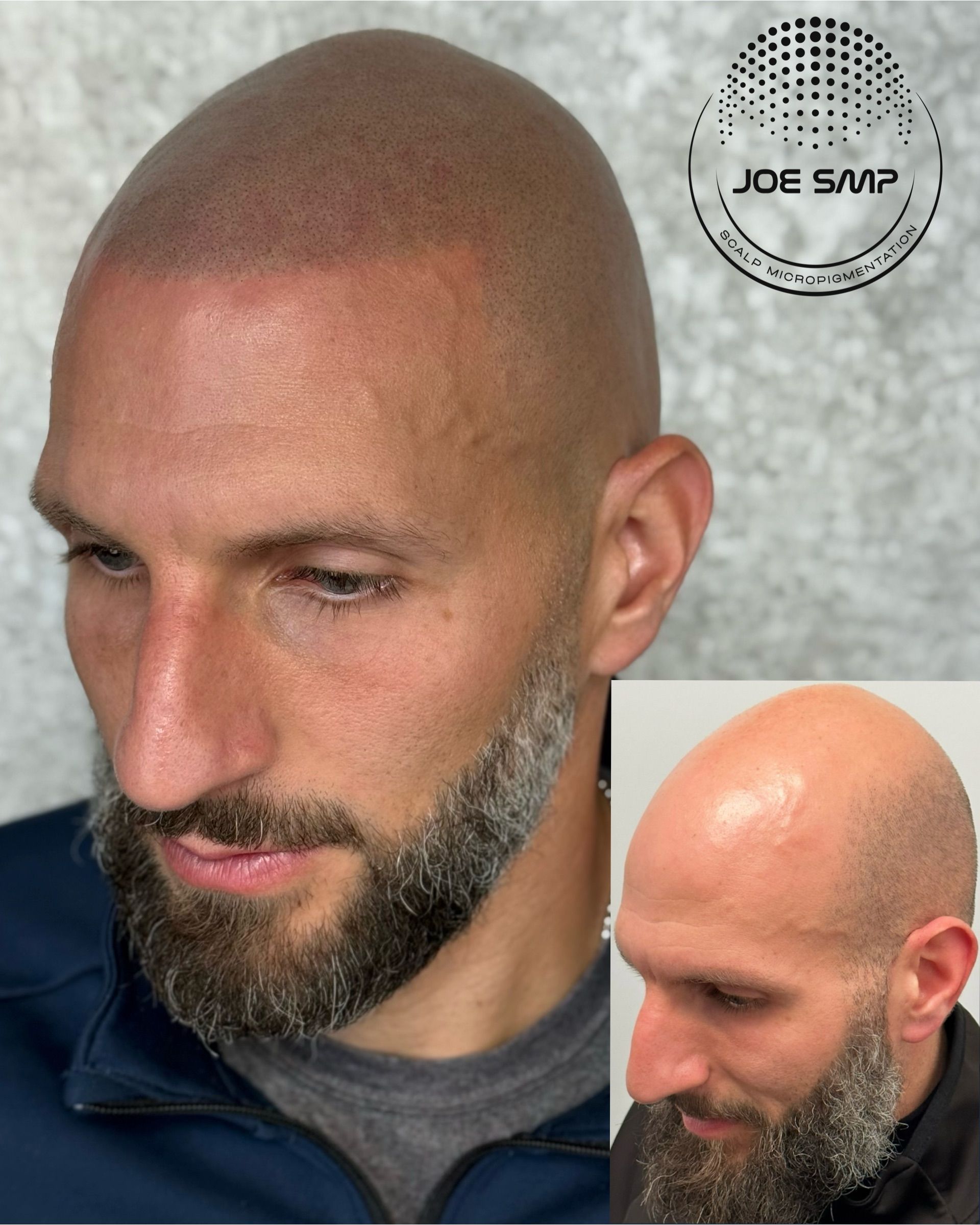 Man with shaved head and beard, showing scalp micropigmentation. Inset shows before treatment.