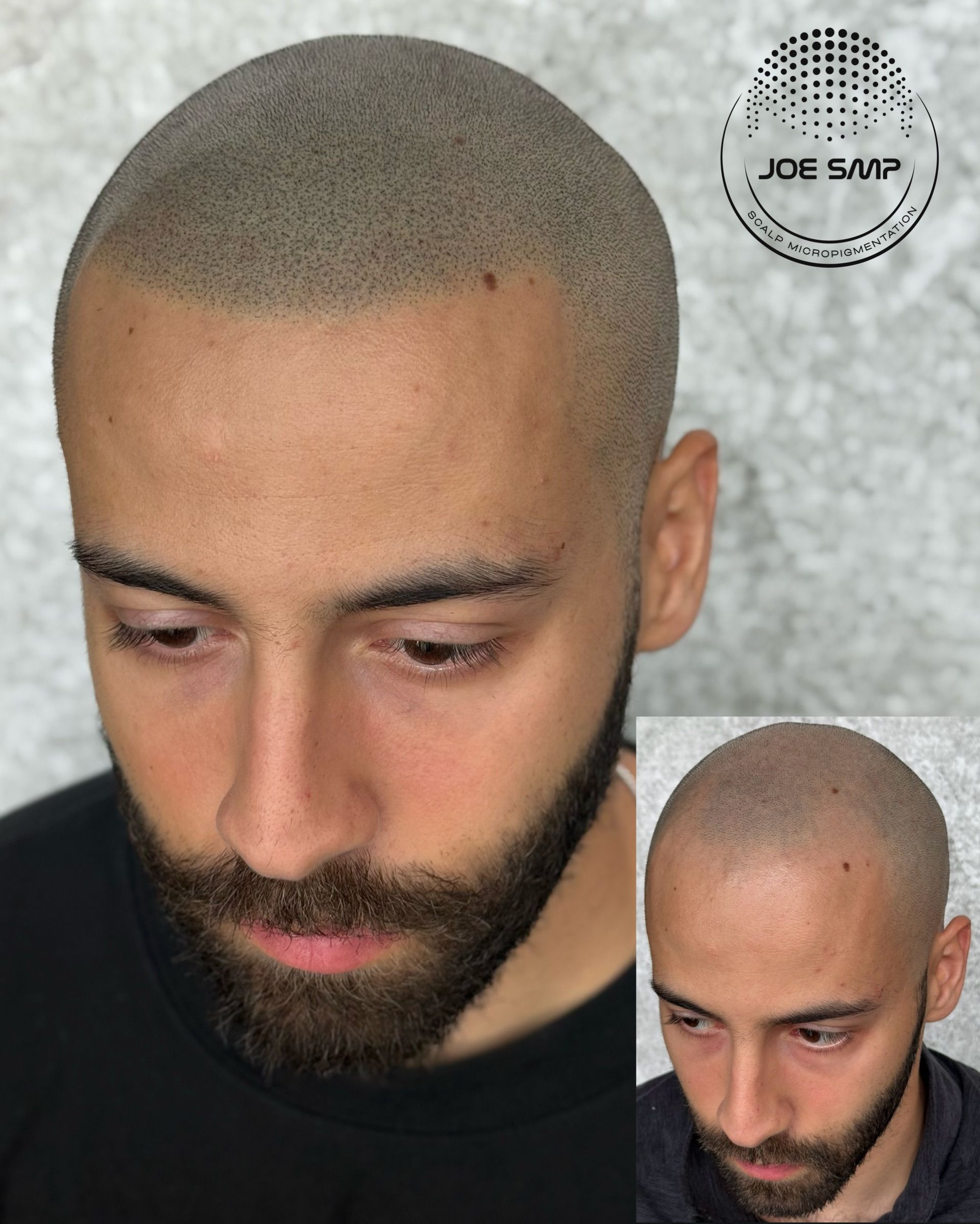 Man with a scalp micropigmentation treatment, close-up with a smaller before-and-after view. Dark hair.