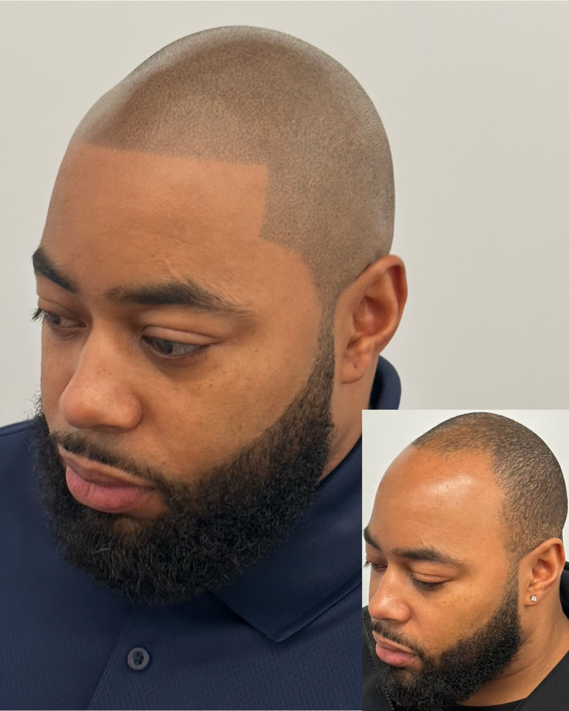 Man with shaved head and beard; a hairline has been created. Inset: Before photo showing hair loss.