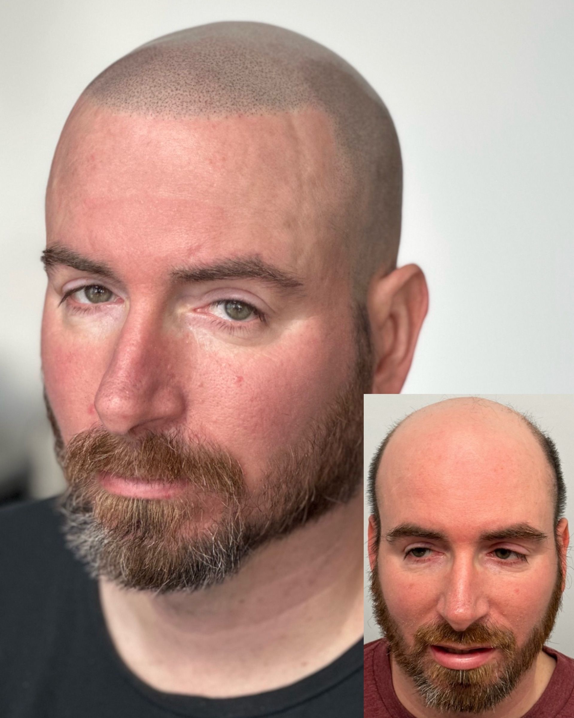 Man with a shaved head and beard, comparison shows before (bald) and after (scalp micropigmentation).