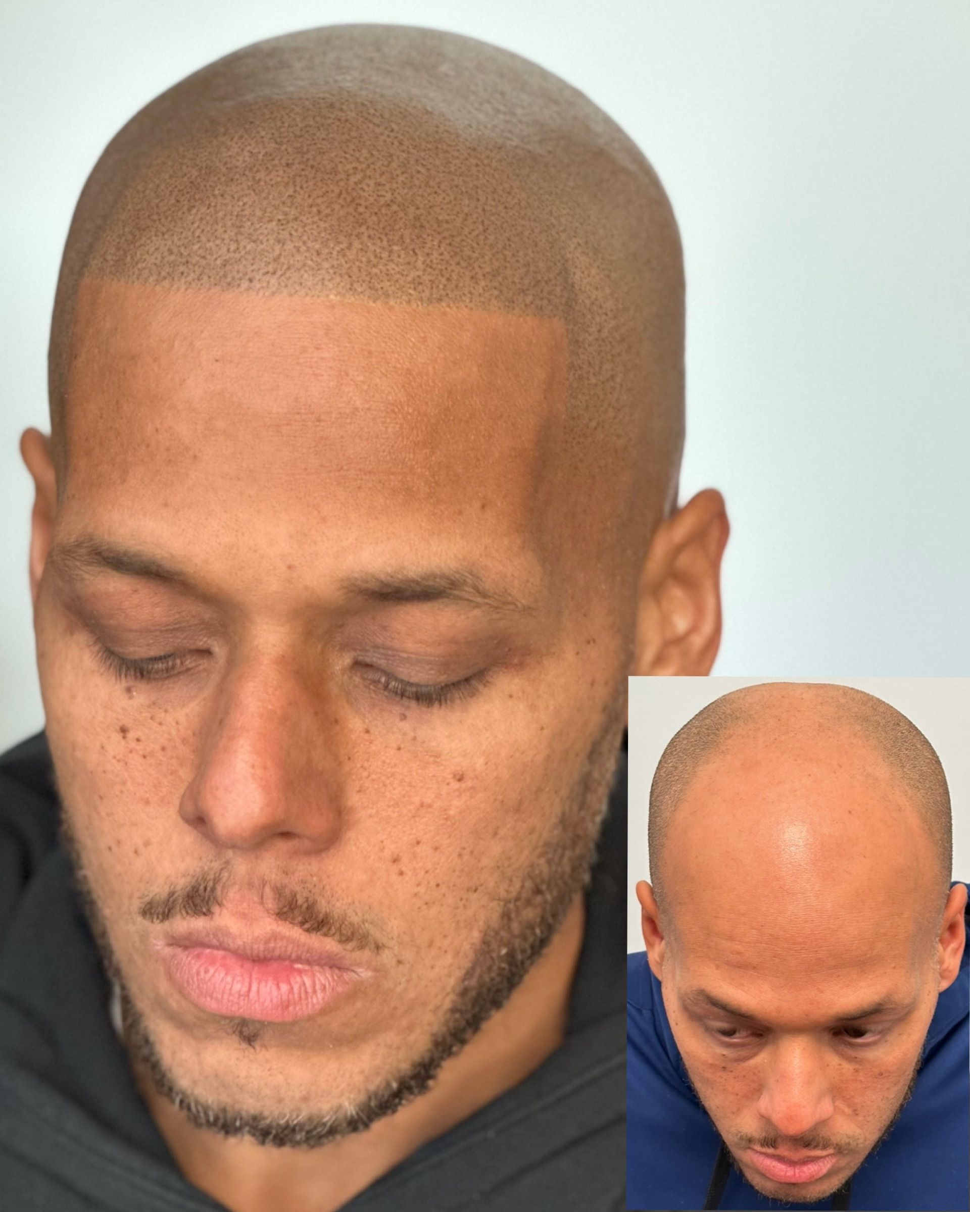 Man with scalp micropigmentation, showcasing before-and-after views.