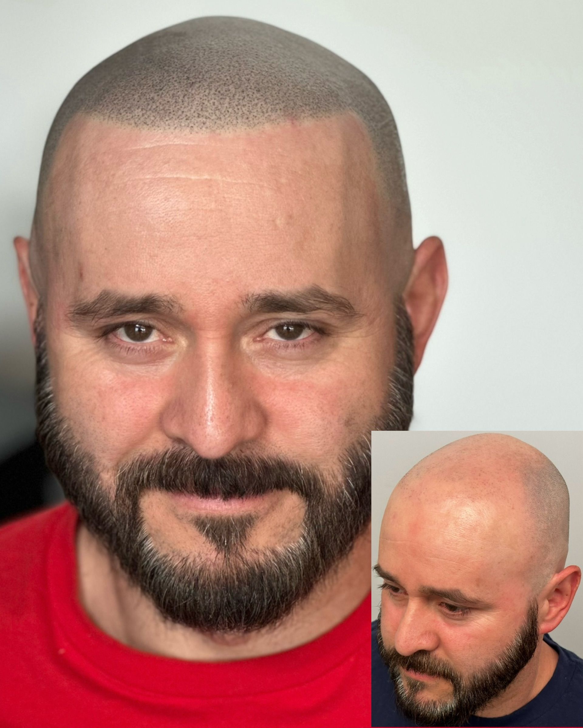 Man with shaved head, beard. Scalp micropigmentation visible. Inset photo shows before.