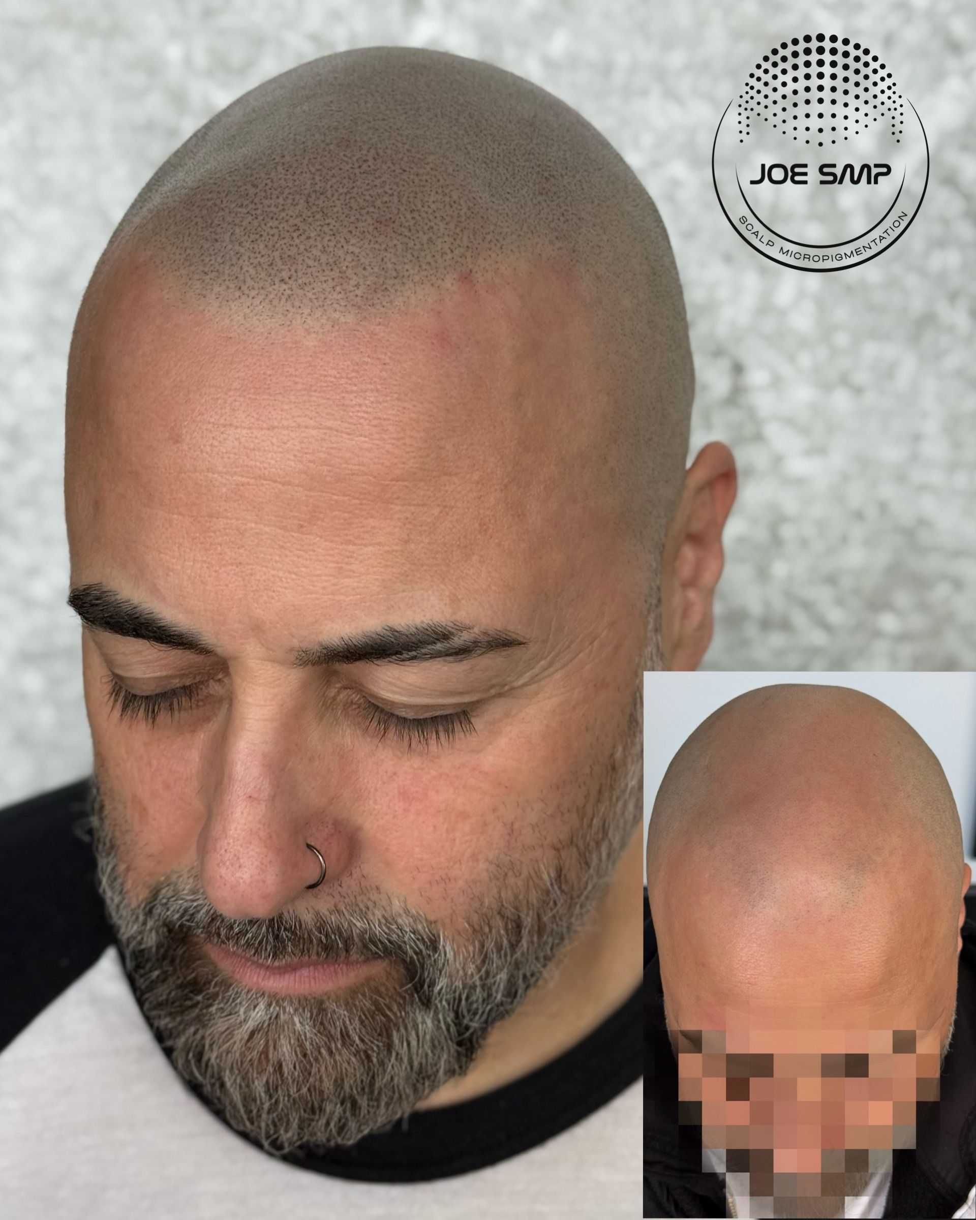 Man with shaved head and beard, receiving Scalp Micropigmentation. Before and after view.