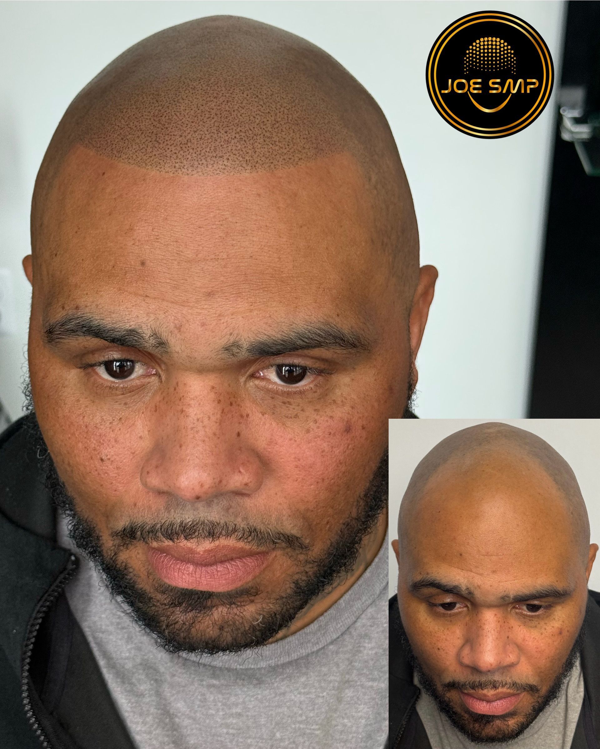 Man with scalp micropigmentation, showing before and after, a cosmetic procedure for hair loss.