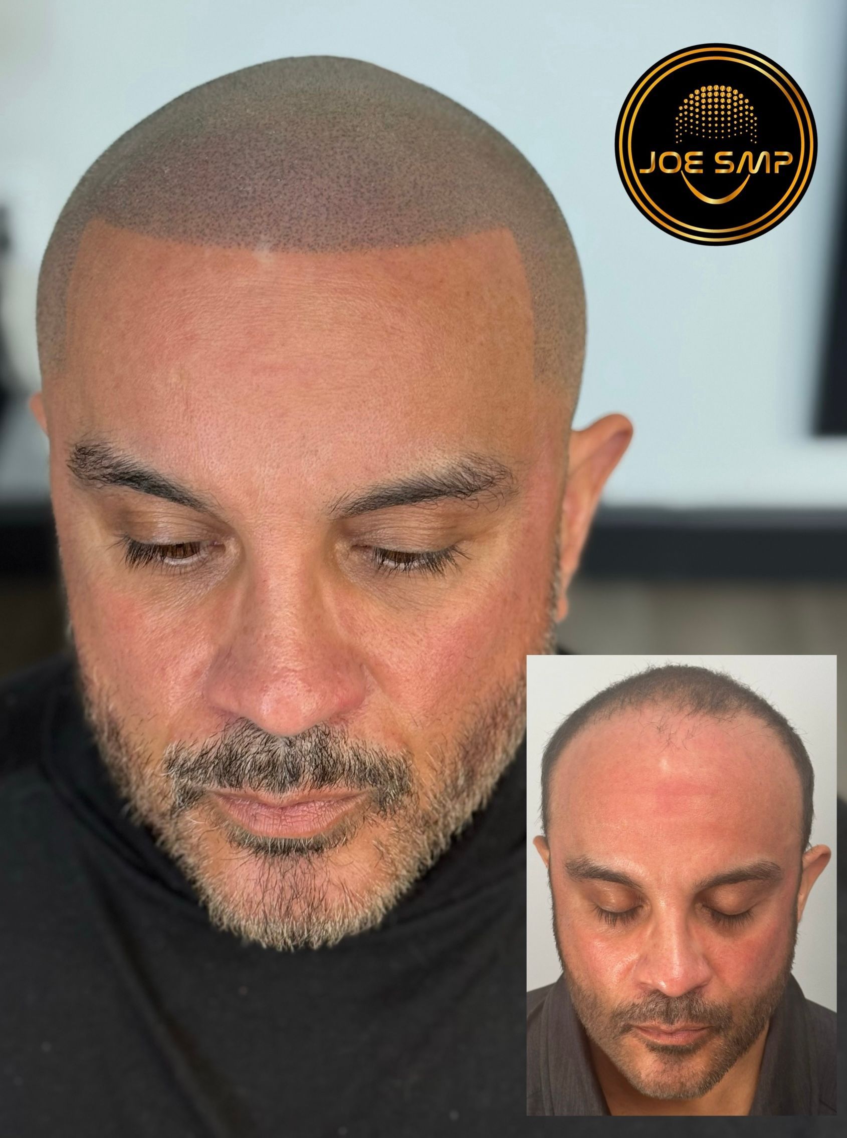 Man with scalp micropigmentation, before and after comparison.