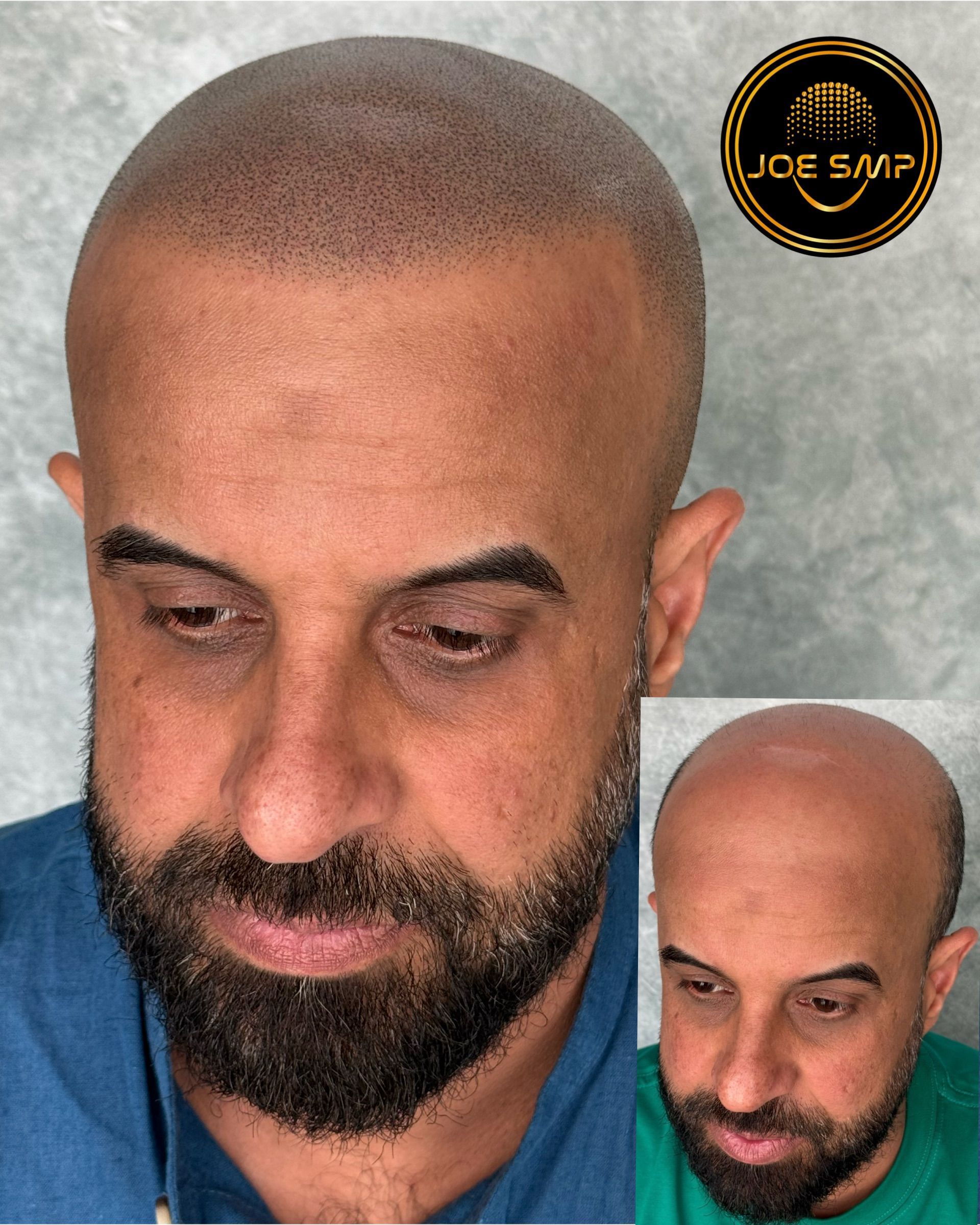 Man with scalp micropigmentation, showcasing a simulated shaved head appearance.