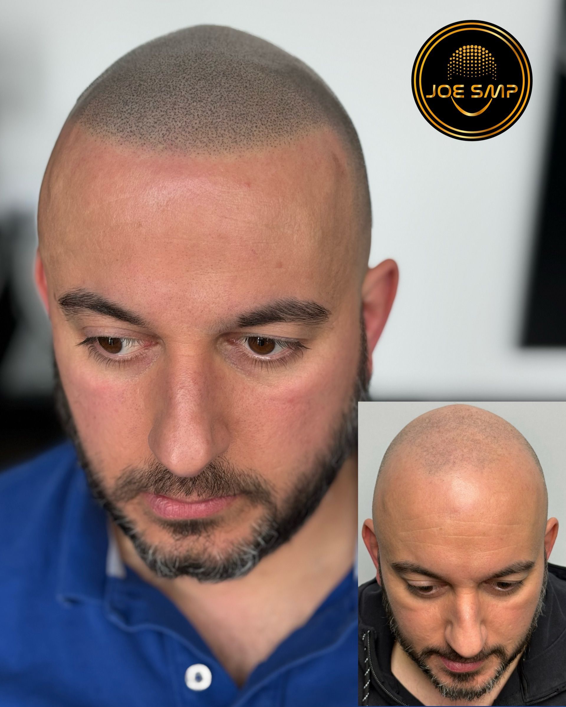 Man with head micropigmentation, before and after view. Close up of the head, adding small dots to simulate hair follicles.