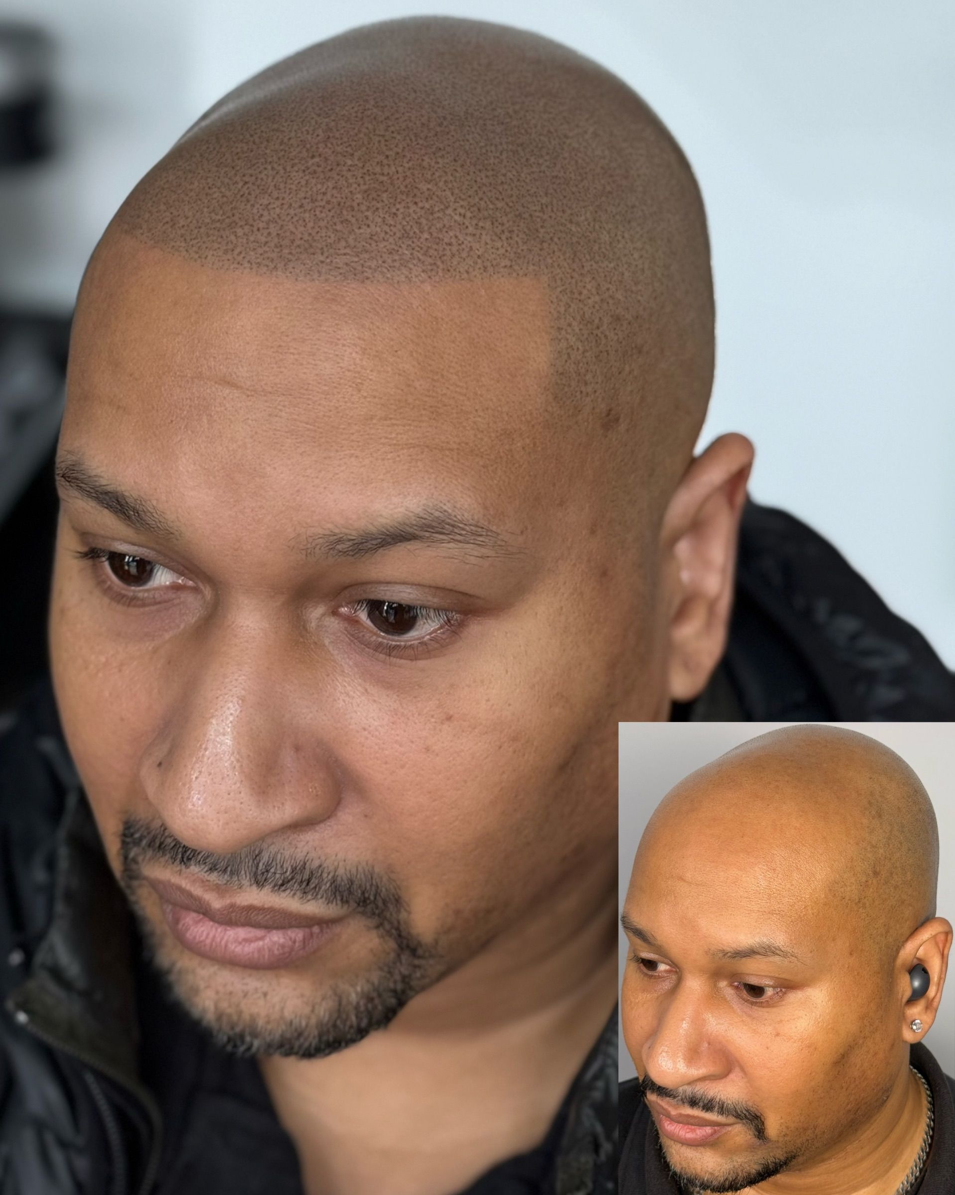 Man with shaved head and scalp micropigmentation, before and after inset.
