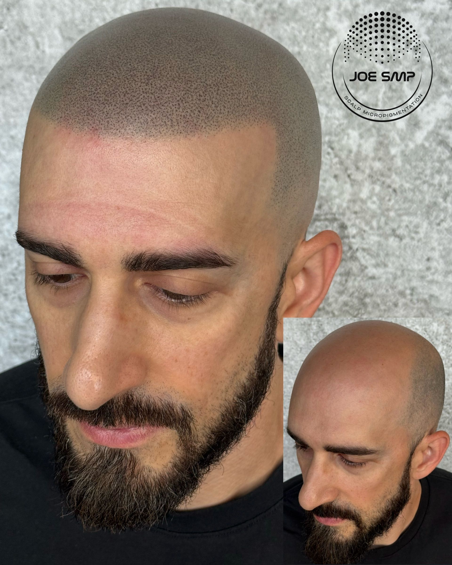 Man with shaved head and beard, showing scalp micropigmentation. Inset of his head without pigmentation.