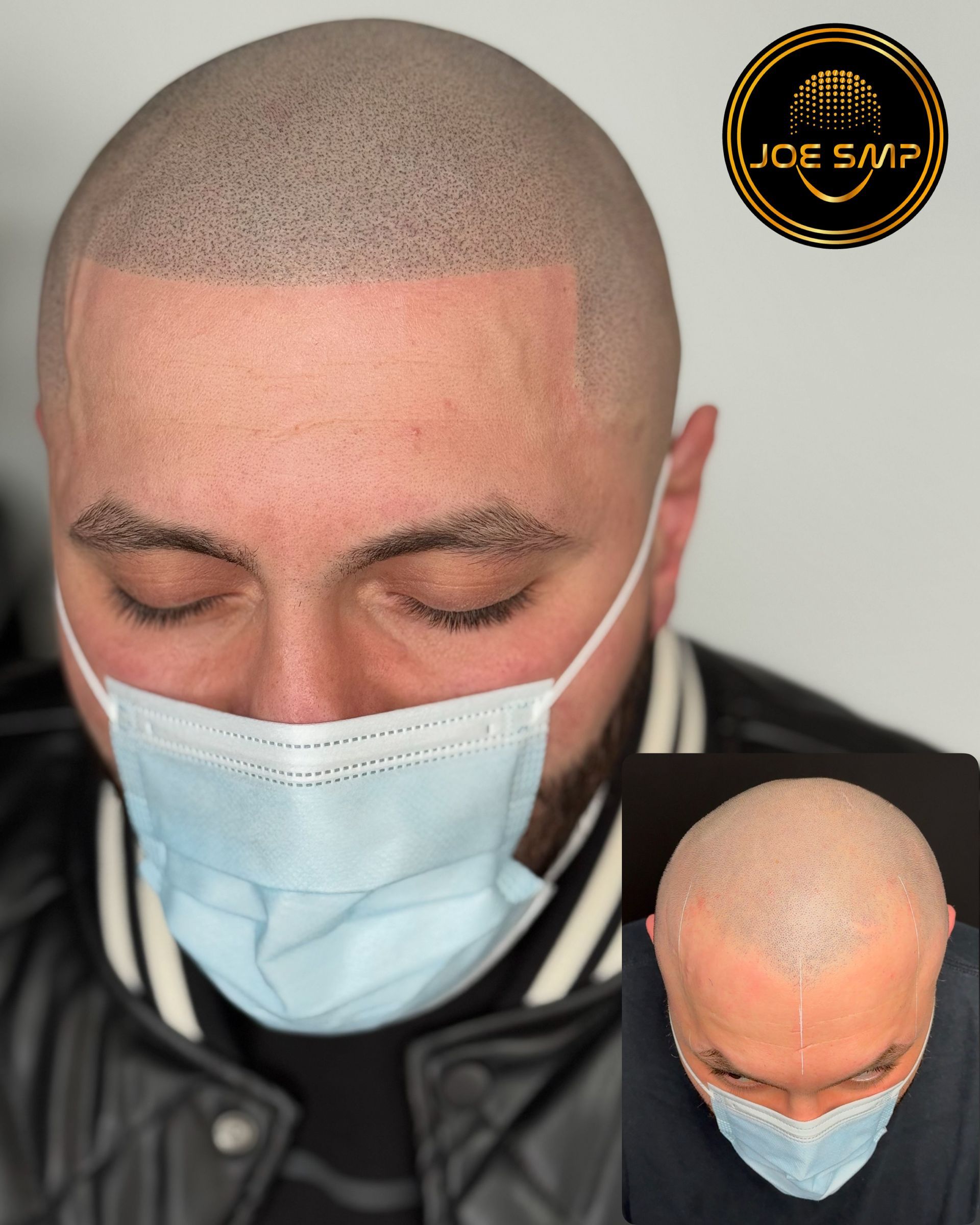 Man with scalp micropigmentation, wearing a mask, and an inset of a top-down view.