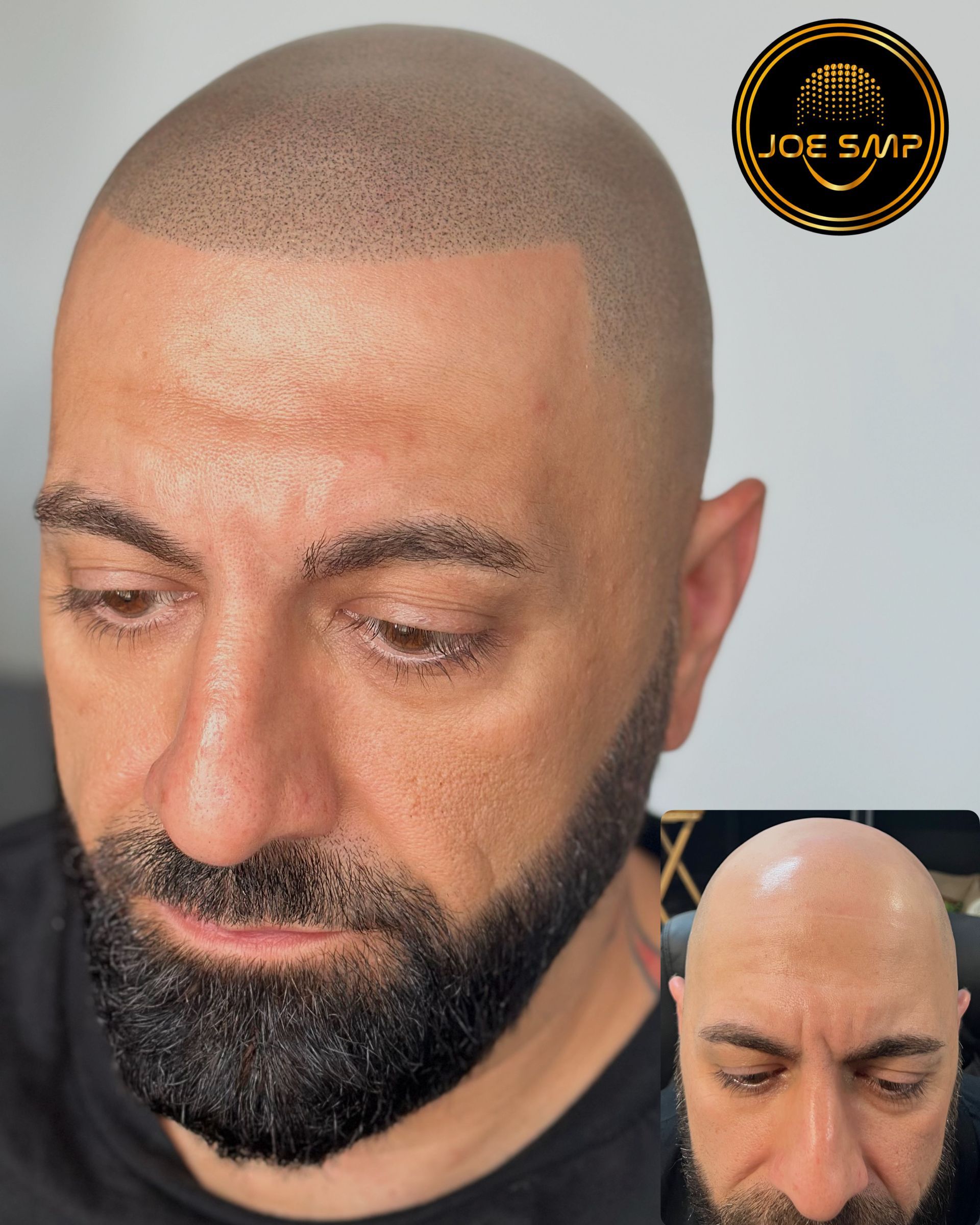 Man with SMP (Scalp Micropigmentation) on a shaved head; before/after comparison shows hair follicle simulation.