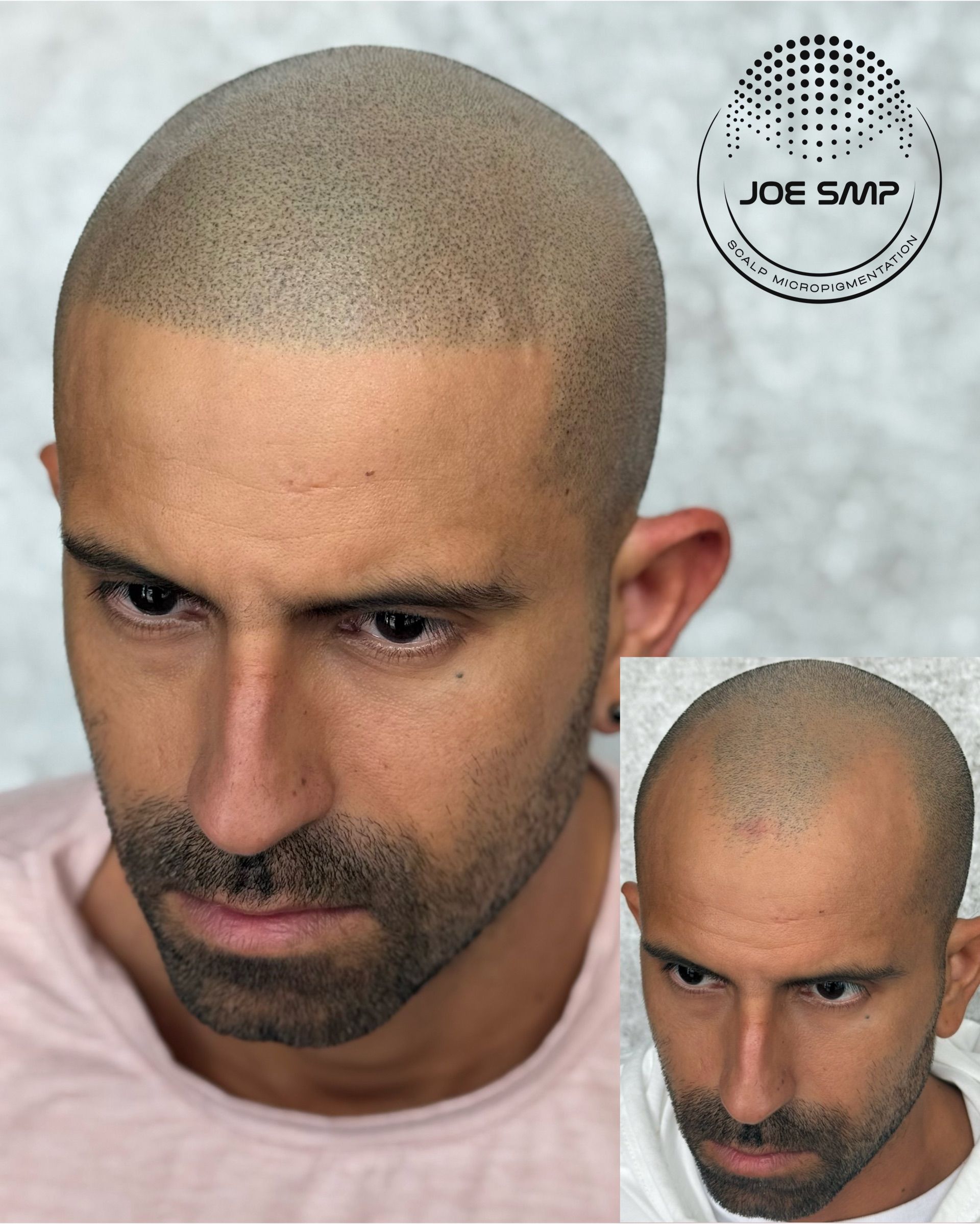 Man with scalp micropigmentation; front and inset views.