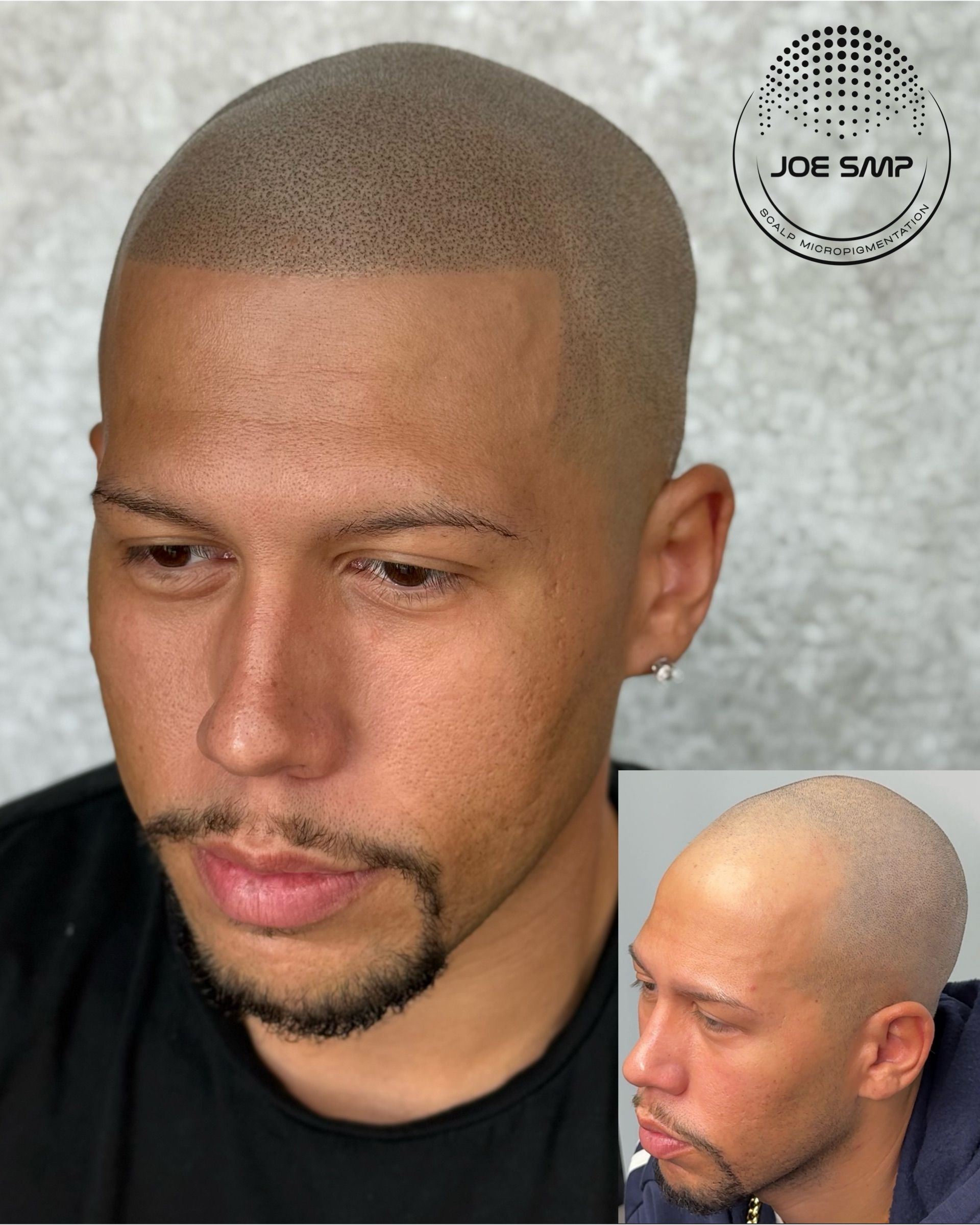Man with shaved head and beard, receiving scalp micropigmentation. Inset shows before. Gray background.