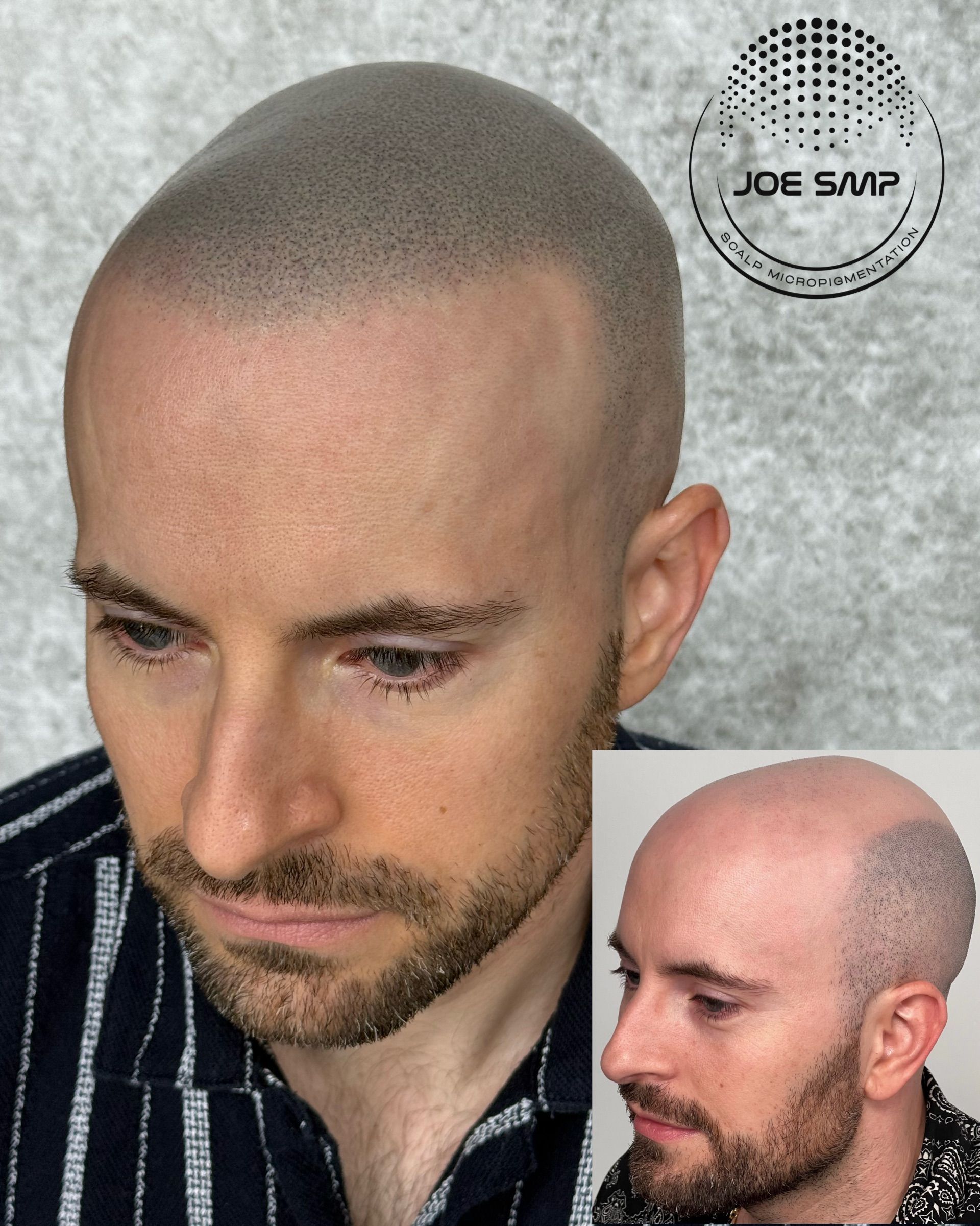 Man with shaved head and scalp micropigmentation, before and after comparison.