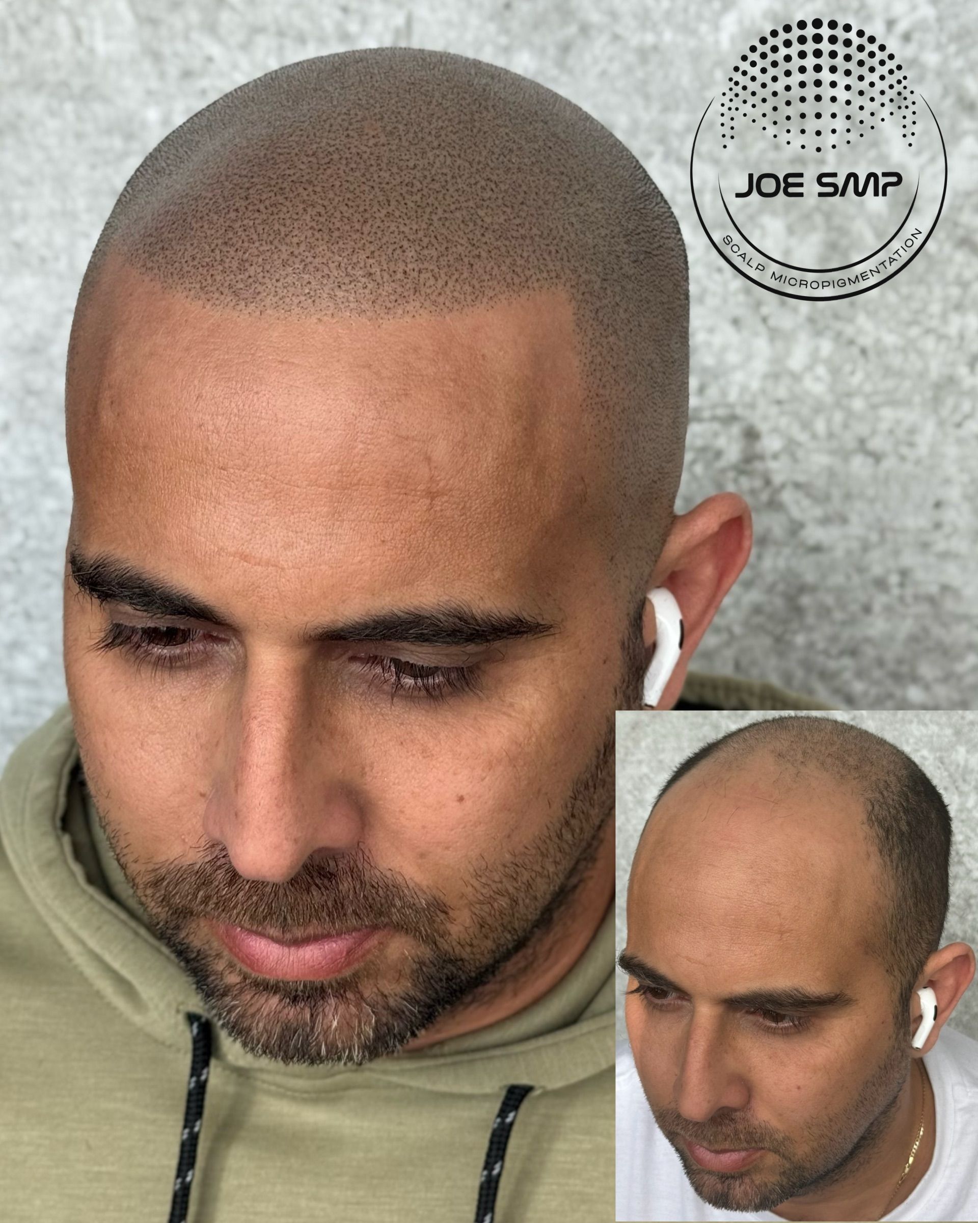 Man with scalp micropigmentation, before and after comparison.