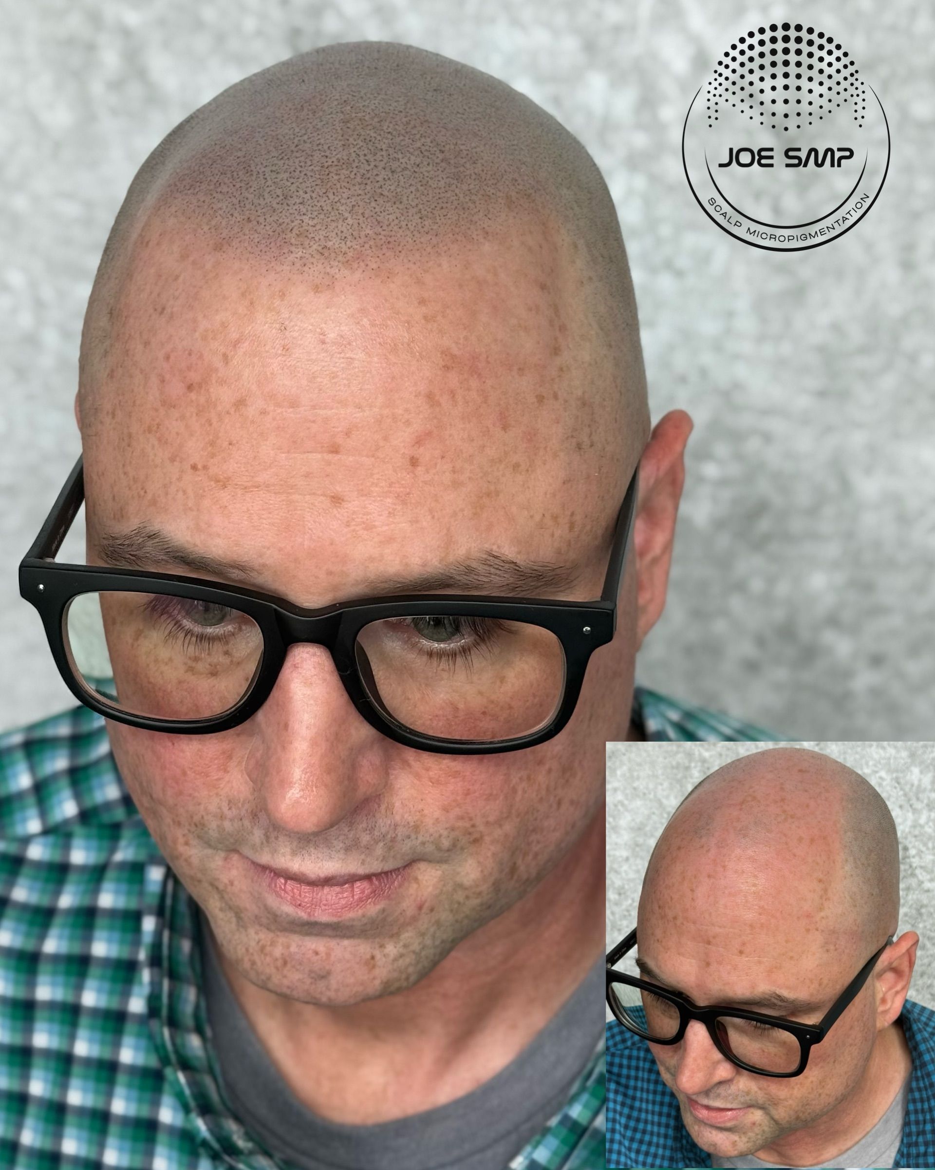 Man with shaved head and glasses, showing scalp micropigmentation. Inset shows another angle.