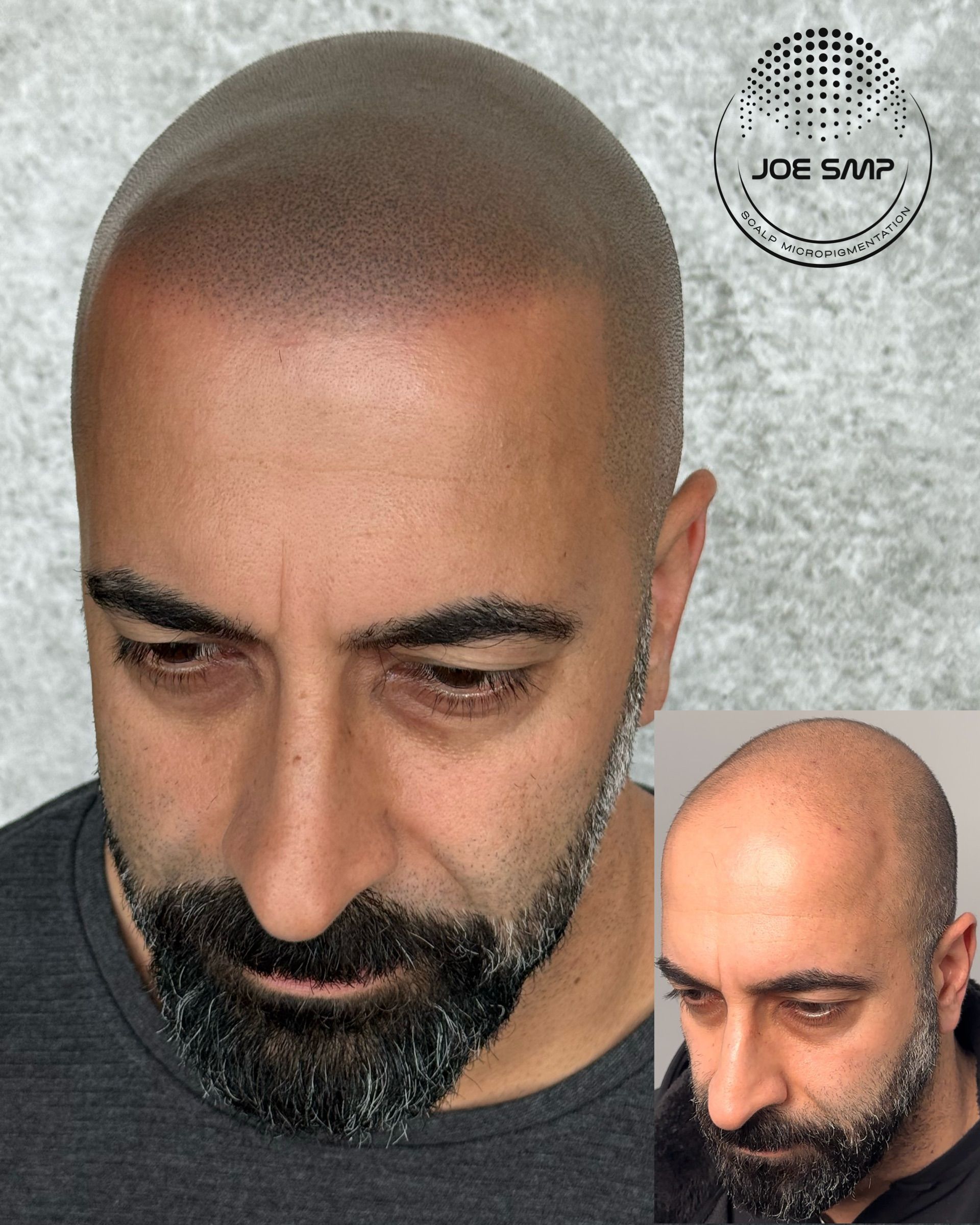 Man with shaved head and beard, showing scalp micropigmentation. Inset shows before treatment.