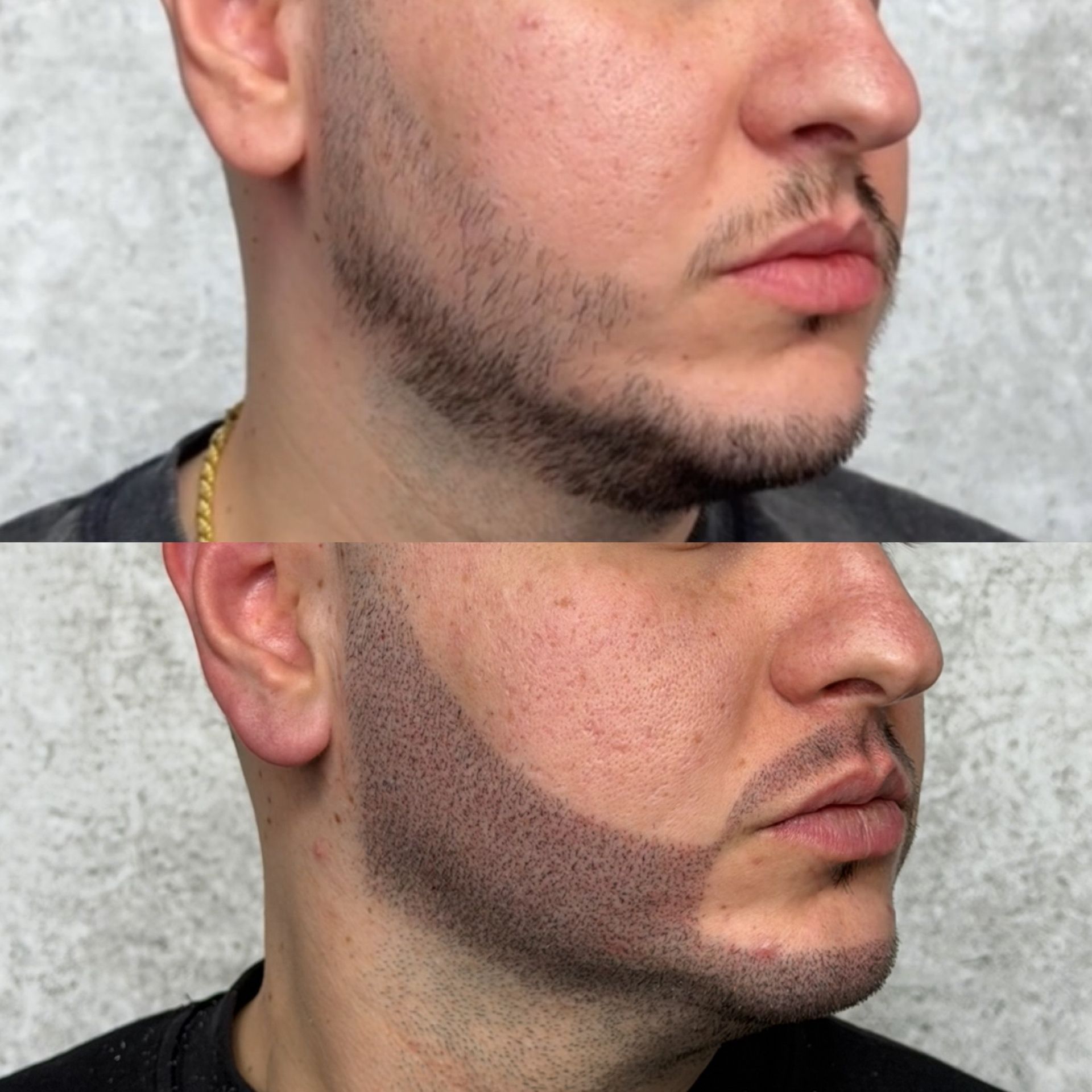 Side-by-side view of a man's face. Top: sparse beard. Bottom: beard with added density.