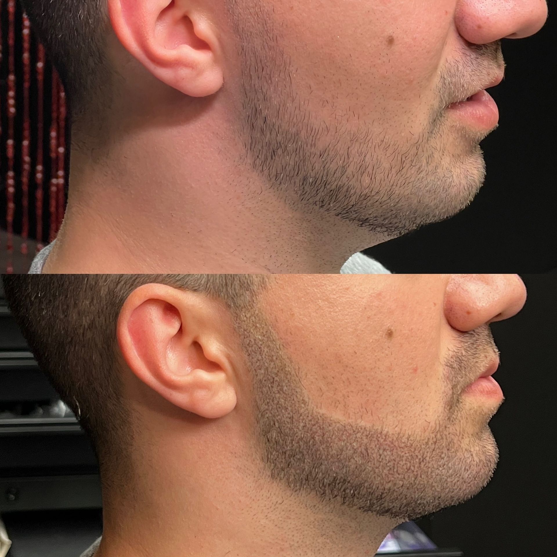Before and after: Man's face profile with trimmed beard and slight neck lift; shows improved definition.