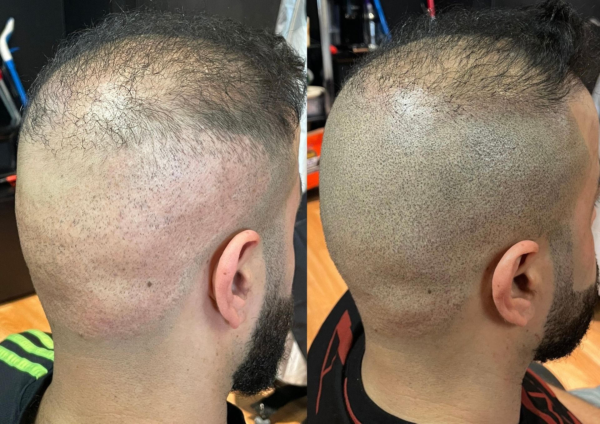 Before and after view of a man's head; hair loss is concealed with a scalp micropigmentation.