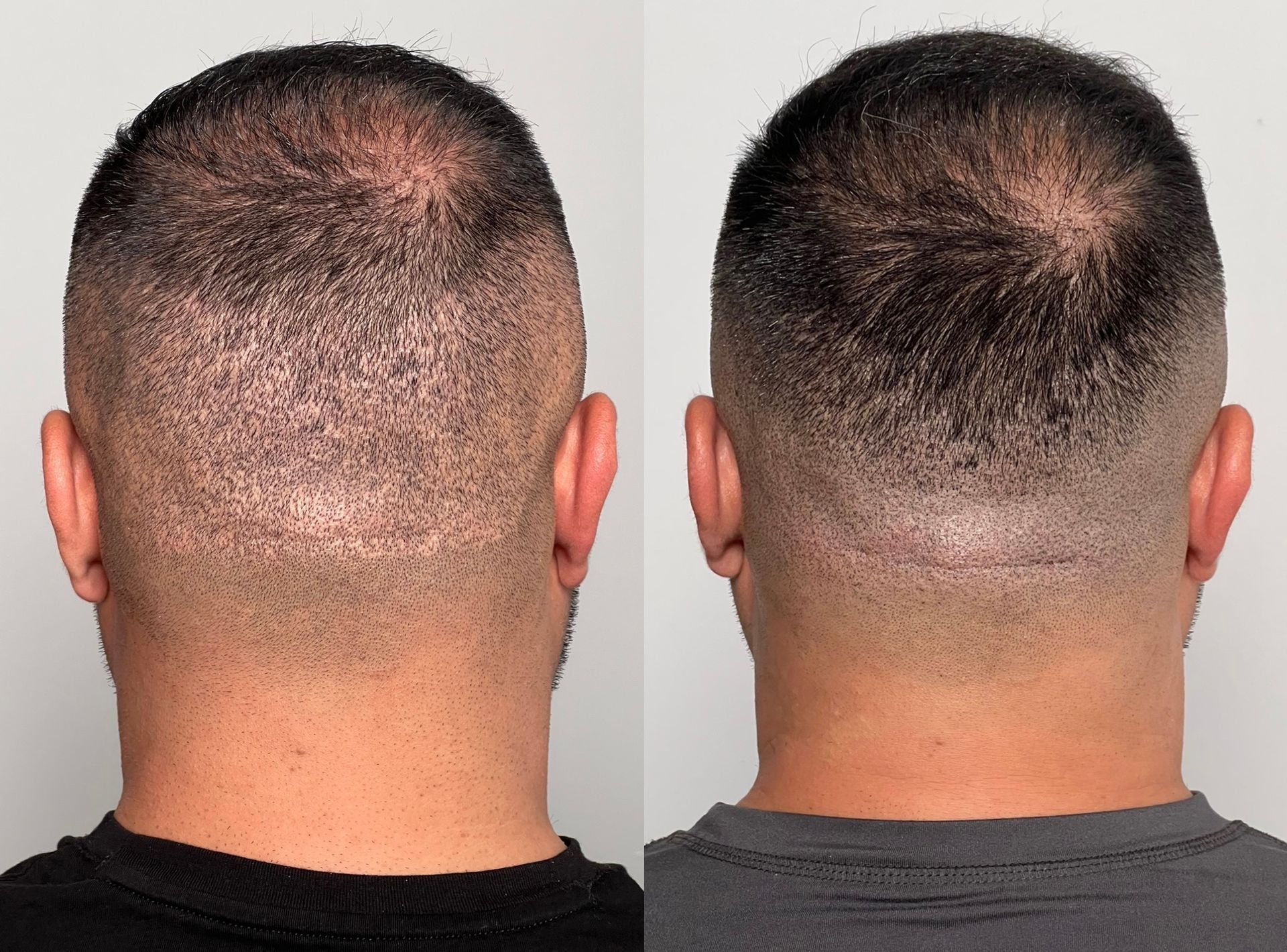 Two rear views of a person's head showing hair loss and scalp treatment, before and after.