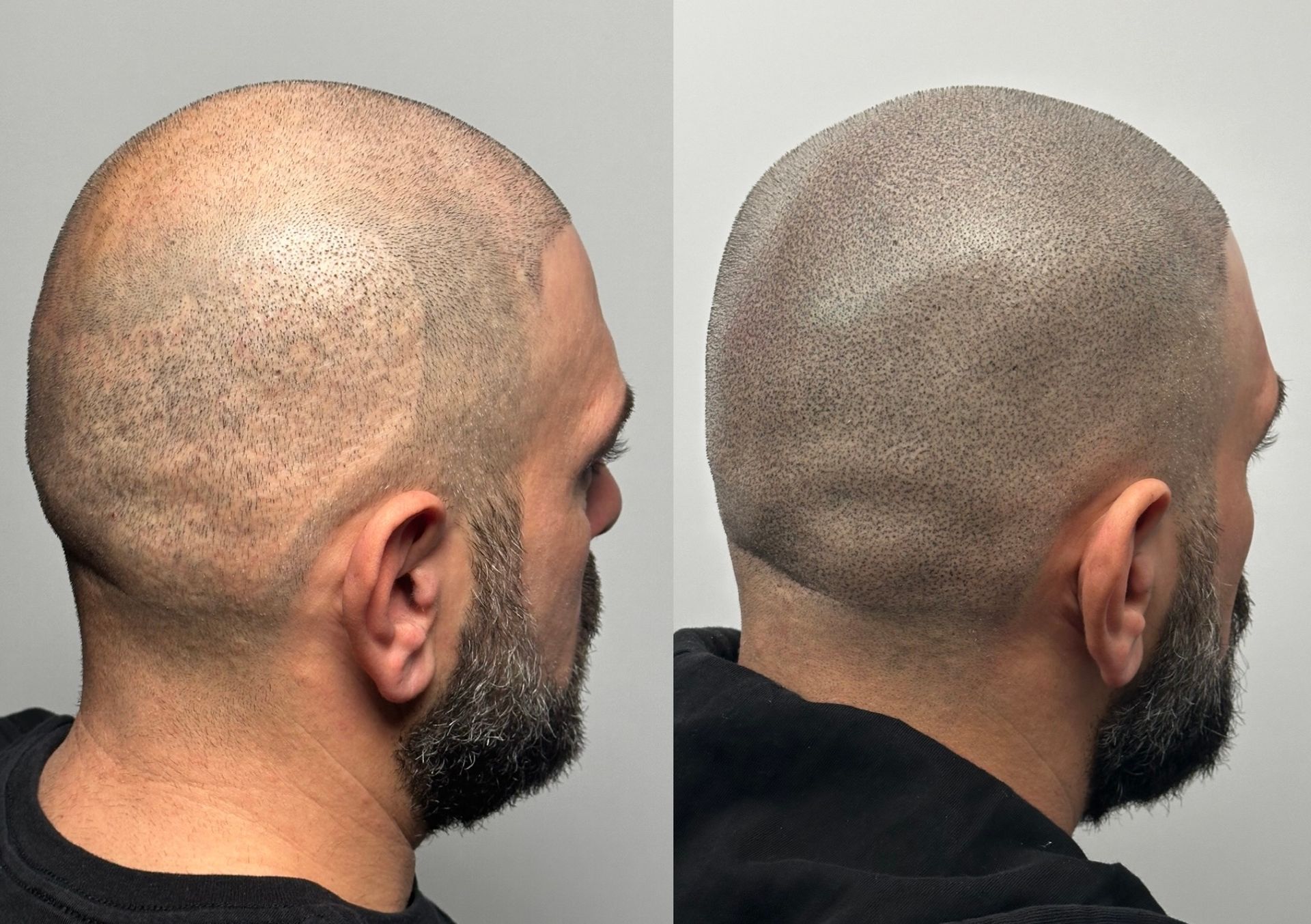 Side-by-side comparison of a man's head before and after Scalp Micropigmentation (SMP), showing a denser, fuller appearance.