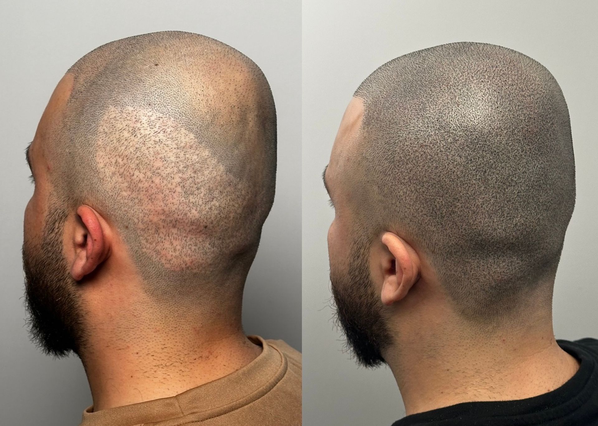 Before and after of scalp micropigmentation, creating a shaved head appearance.