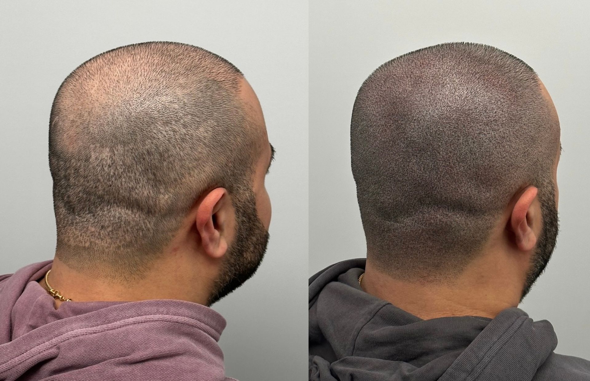 Before and after views of a man's head, showing hair growth following a procedure.