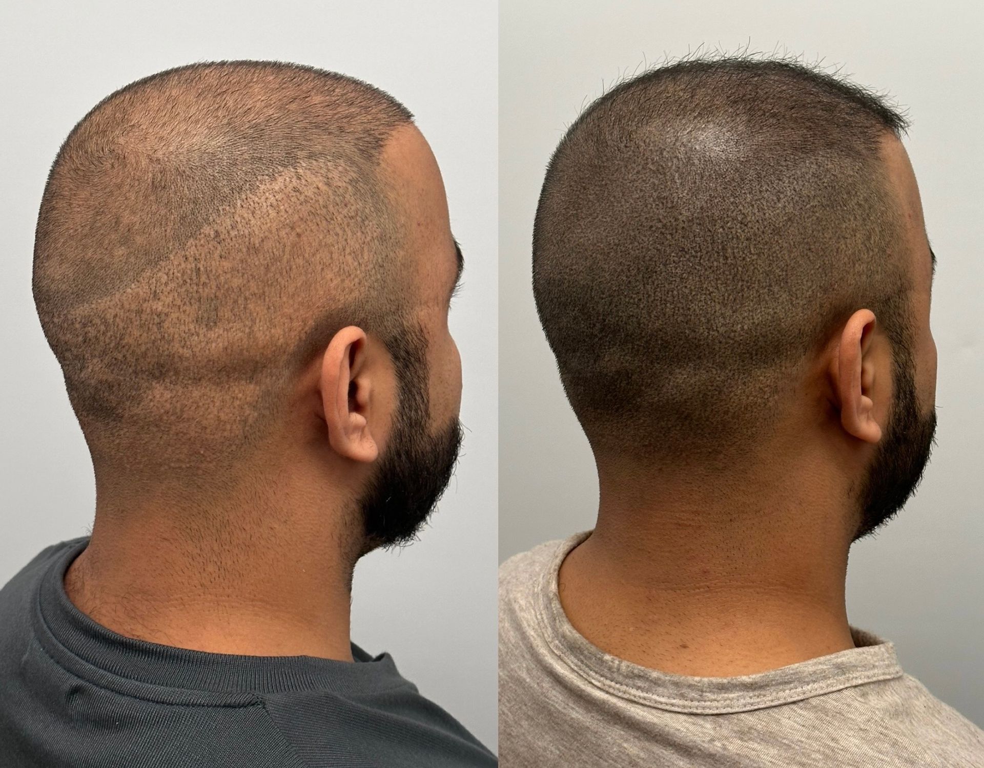 Before and after comparison of a person's scalp after hair restoration, showing increased hair density.