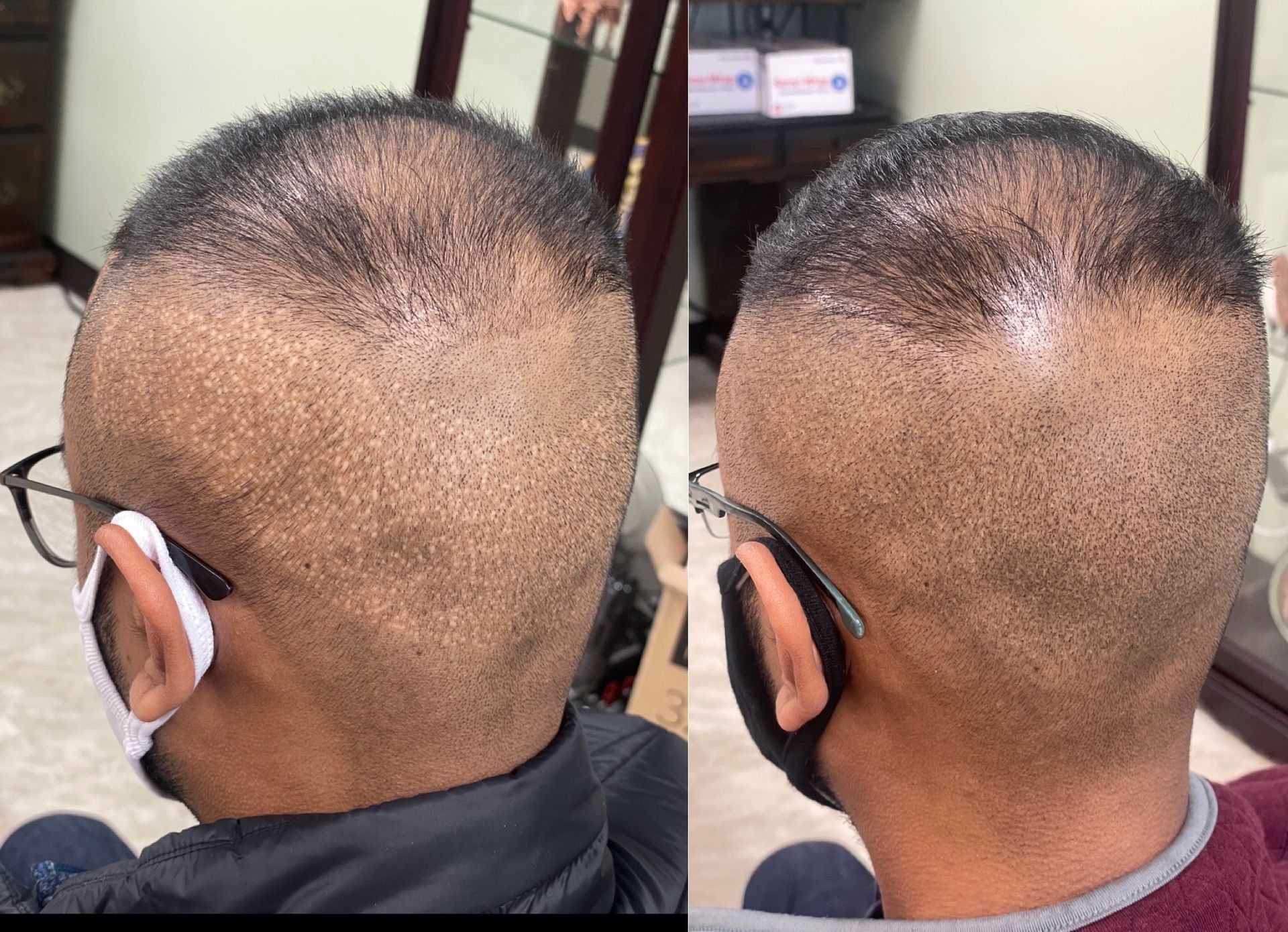 Two side-by-side views of a person's head, showing hair growth post-hair transplant surgery.