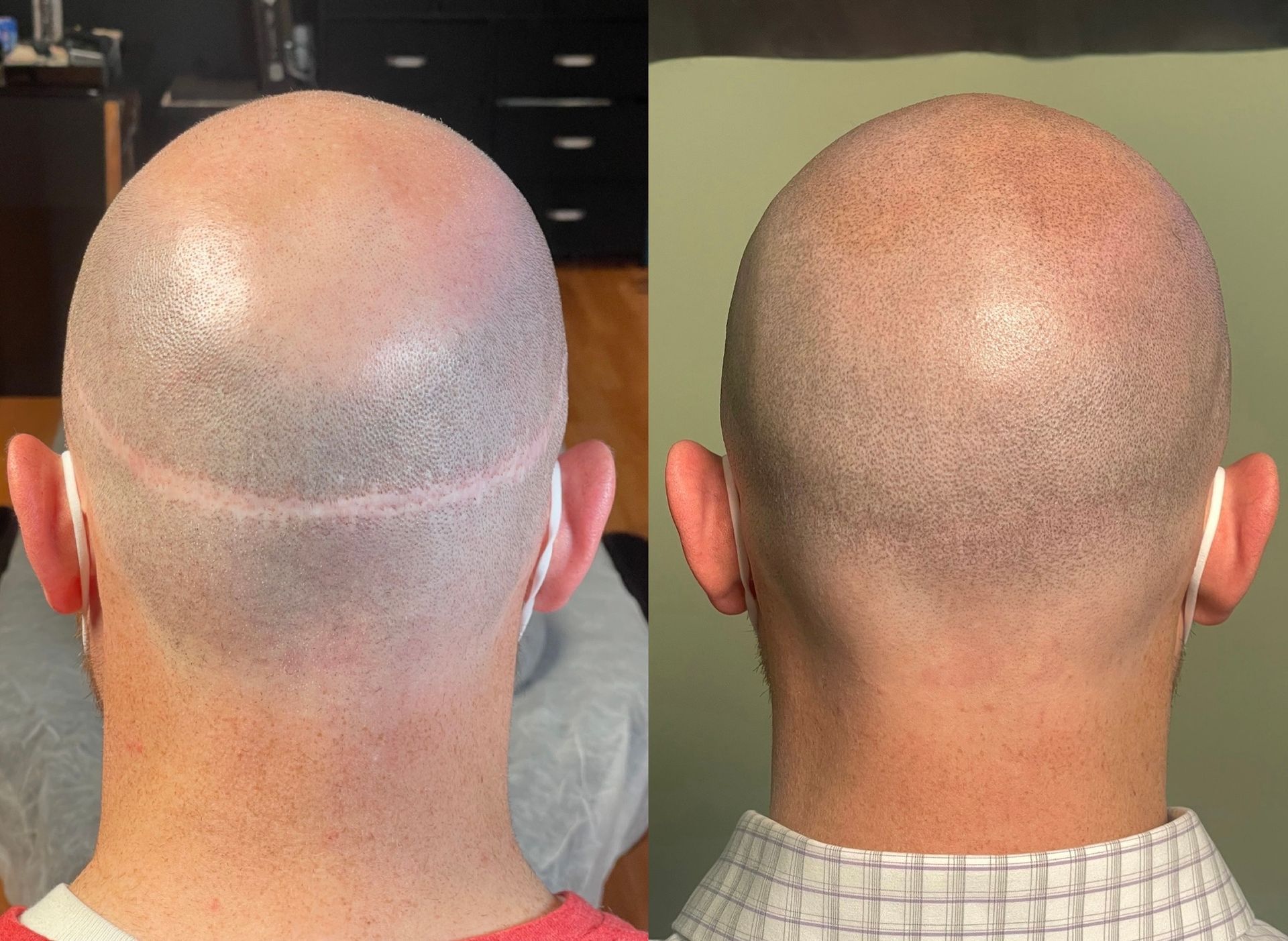 Two views of a shaved head; left shows a scar, right shows a healed, dotted scalp.