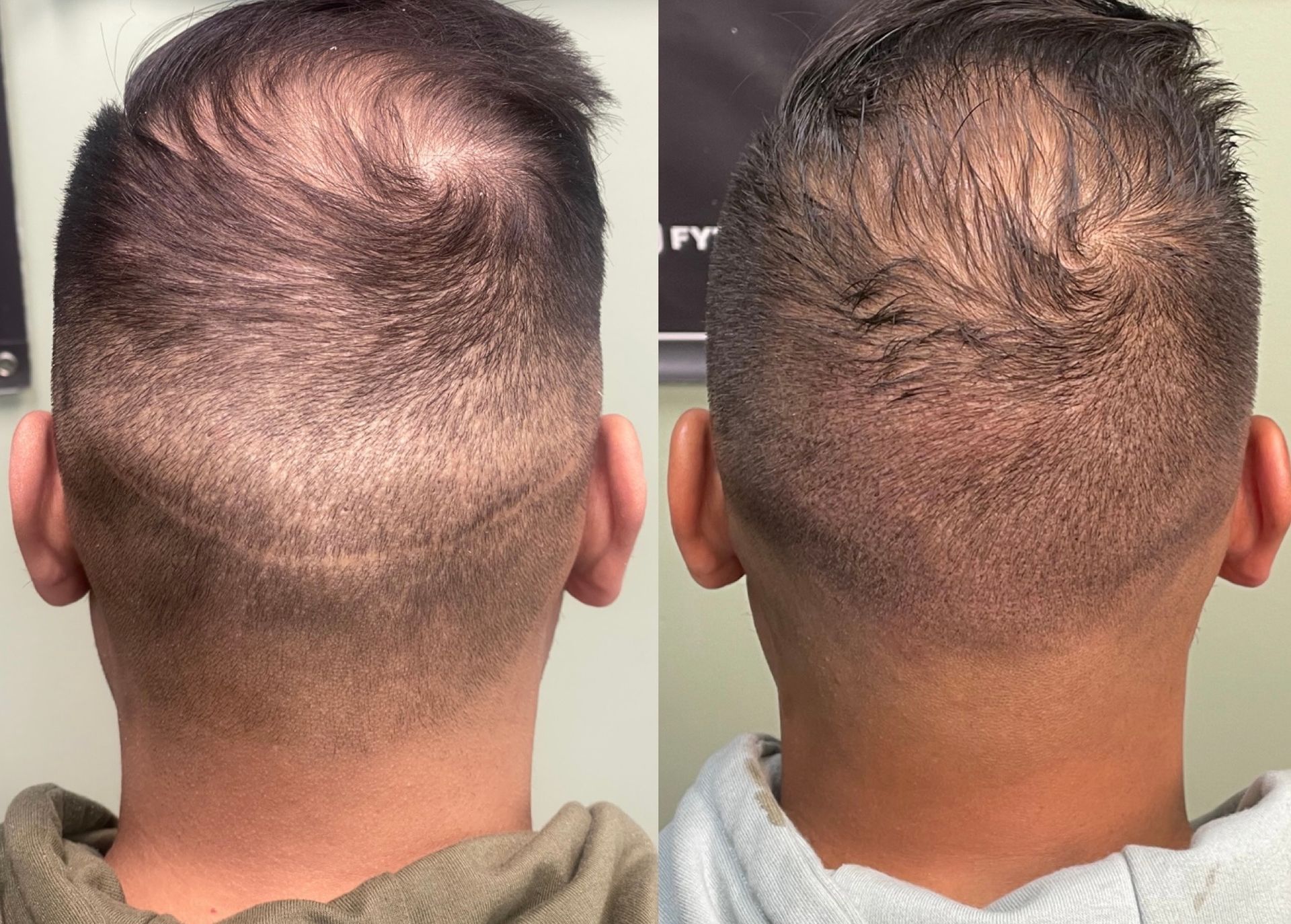 Two views of the back of a person's head, showing a shaved haircut. Hair loss visible in crown.