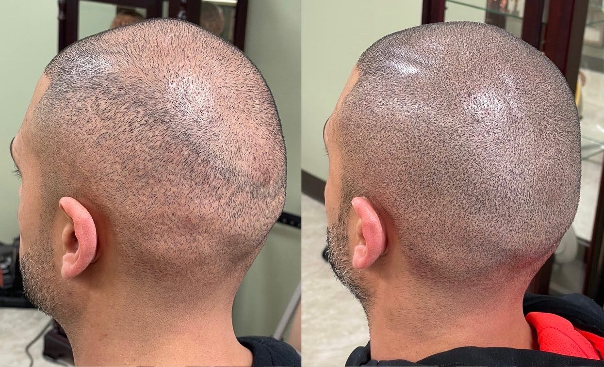 Two side-by-side views of a head treated with scalp micropigmentation. Dark dots mimic a shaved head.