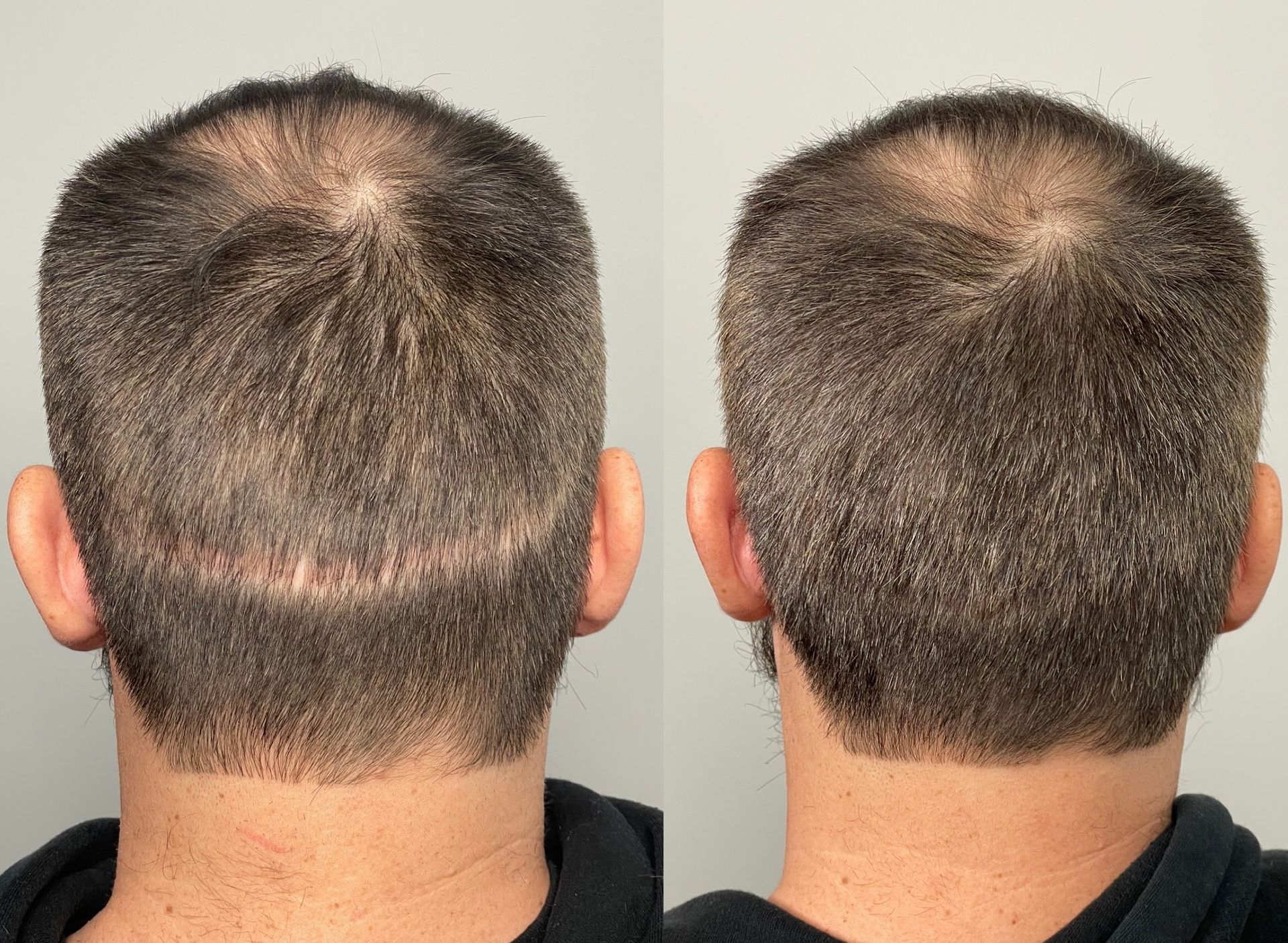 Before and after view of a man's scalp. The first shows a scar, the second shows the healed area with hair.