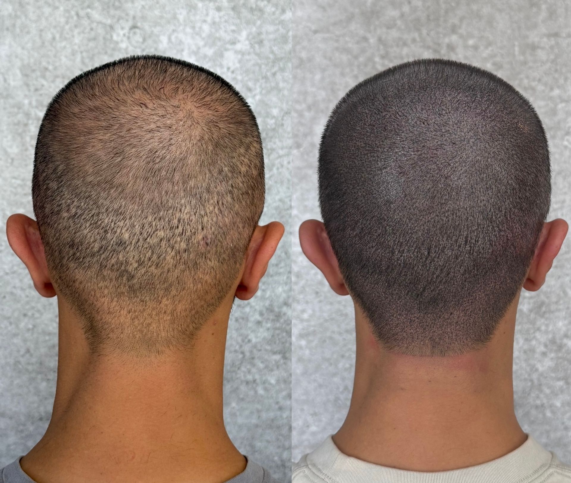 Two views of the back of a shaved head; left side shows hair loss, right side shows scalp micropigmentation.