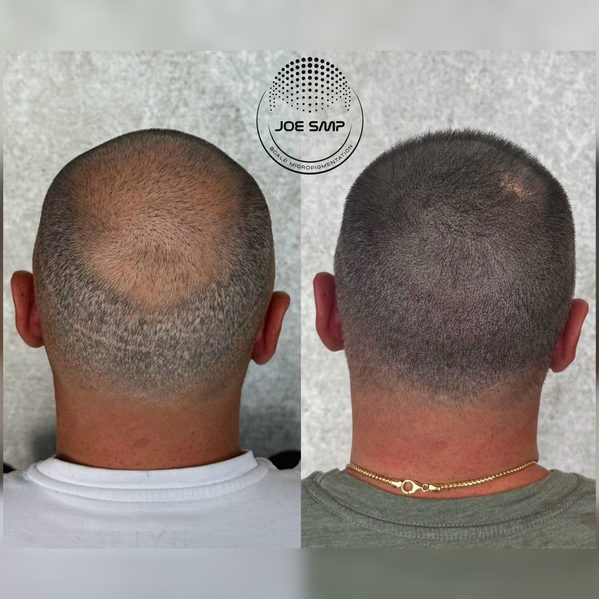 Before and after scalp micropigmentation on a man, showing hair loss coverage.