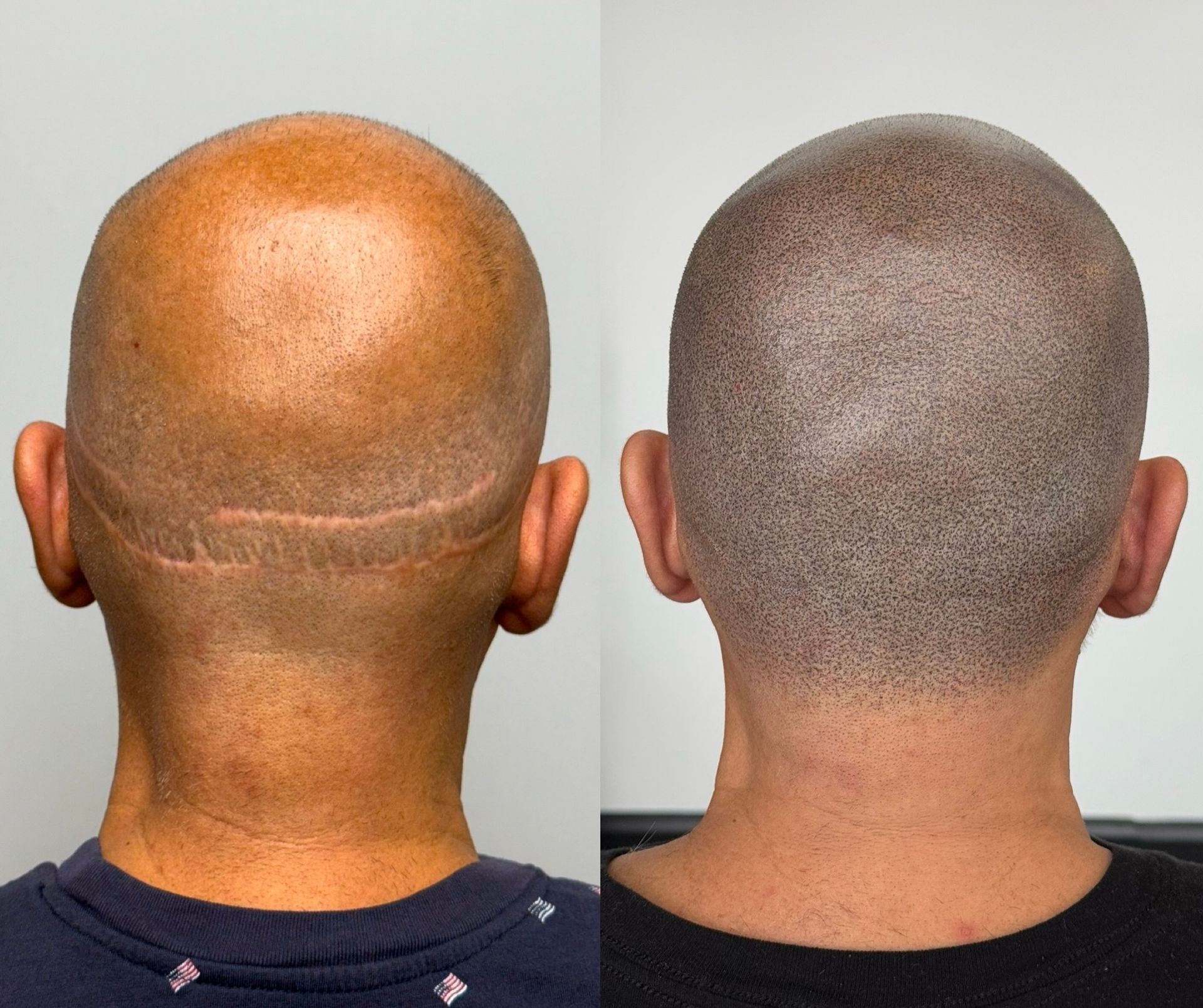 Scalp micropigmentation: Before and after view of a shaved head, showing scar improvement and hair follicle simulation.