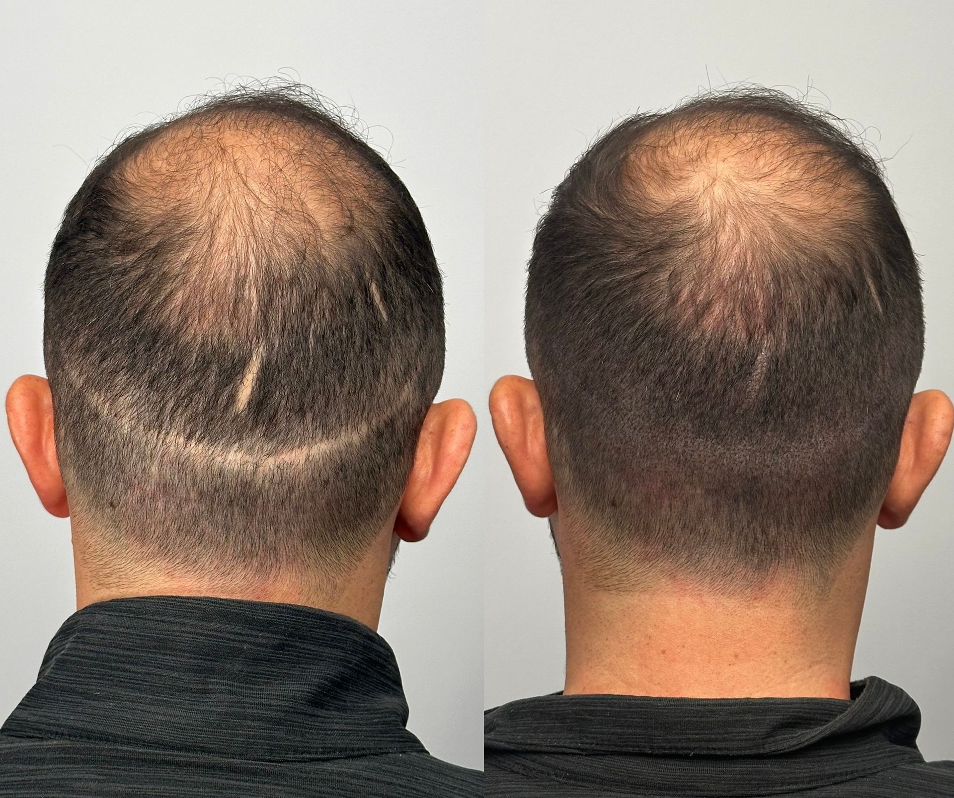 Before and after view of a shaved head. Visible hair loss and scar on the back of the head.