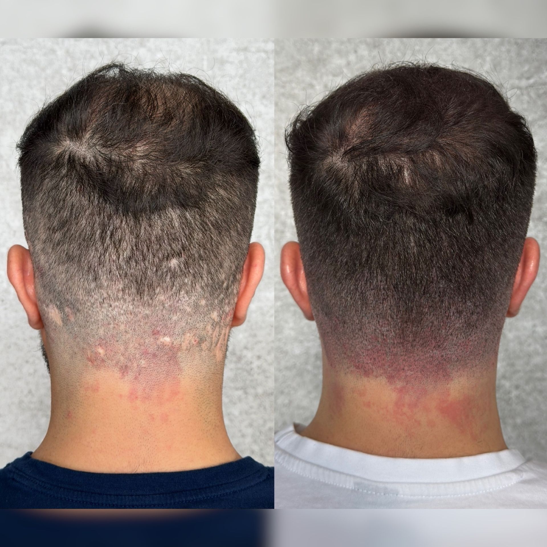 Before and after comparison of the back of a person's head, showing hair growth and reduced redness on the neck.