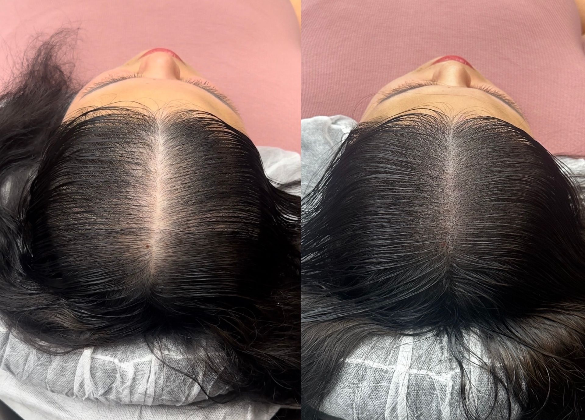 Two overhead views of a person's scalp and hair. Left shows thinner hair; right shows fuller hair, possibly after treatment.