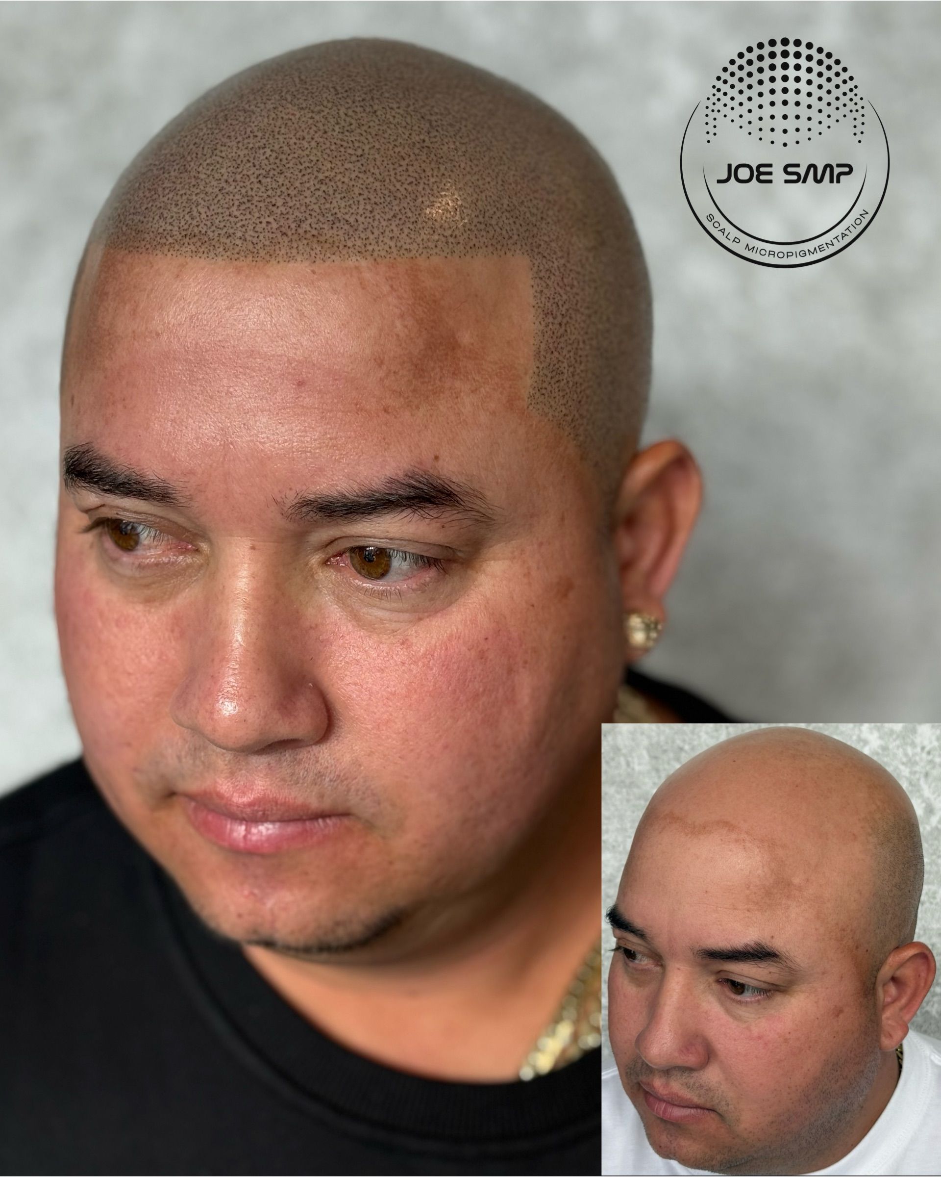 Man with scalp micropigmentation, before and after comparison. Brown dots create a hairline.