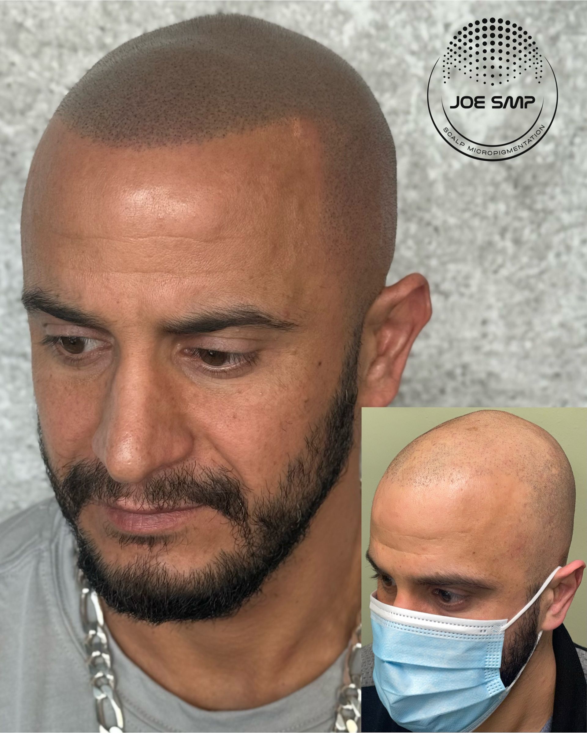 Man with shaved head and beard; scalp micropigmentation. Inset: man wearing a mask.