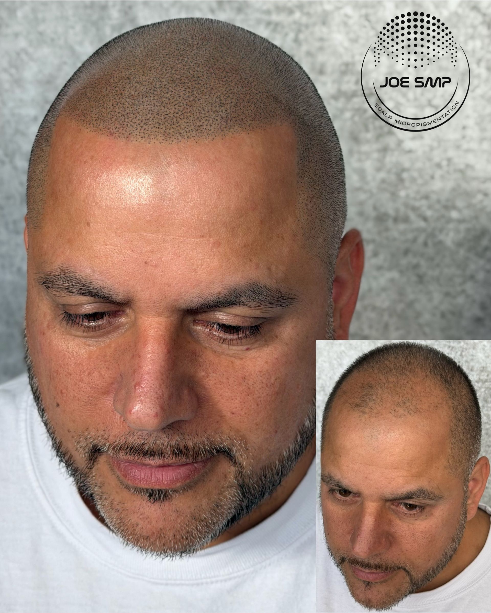 Man with scalp micropigmentation, close-up with a smaller image inset. Scalp appears dotted.
