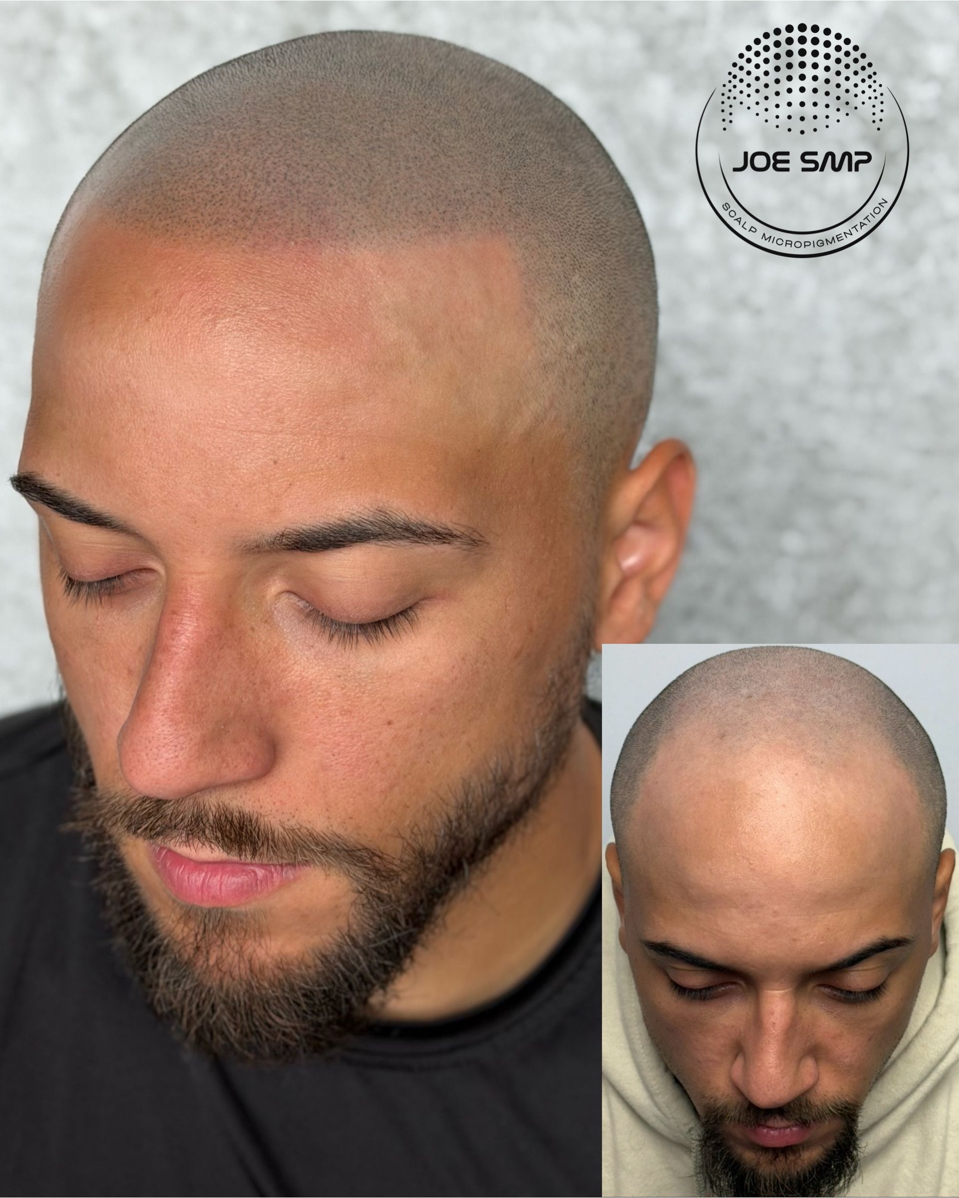 Man with scalp micropigmentation, showcasing before-and-after views.