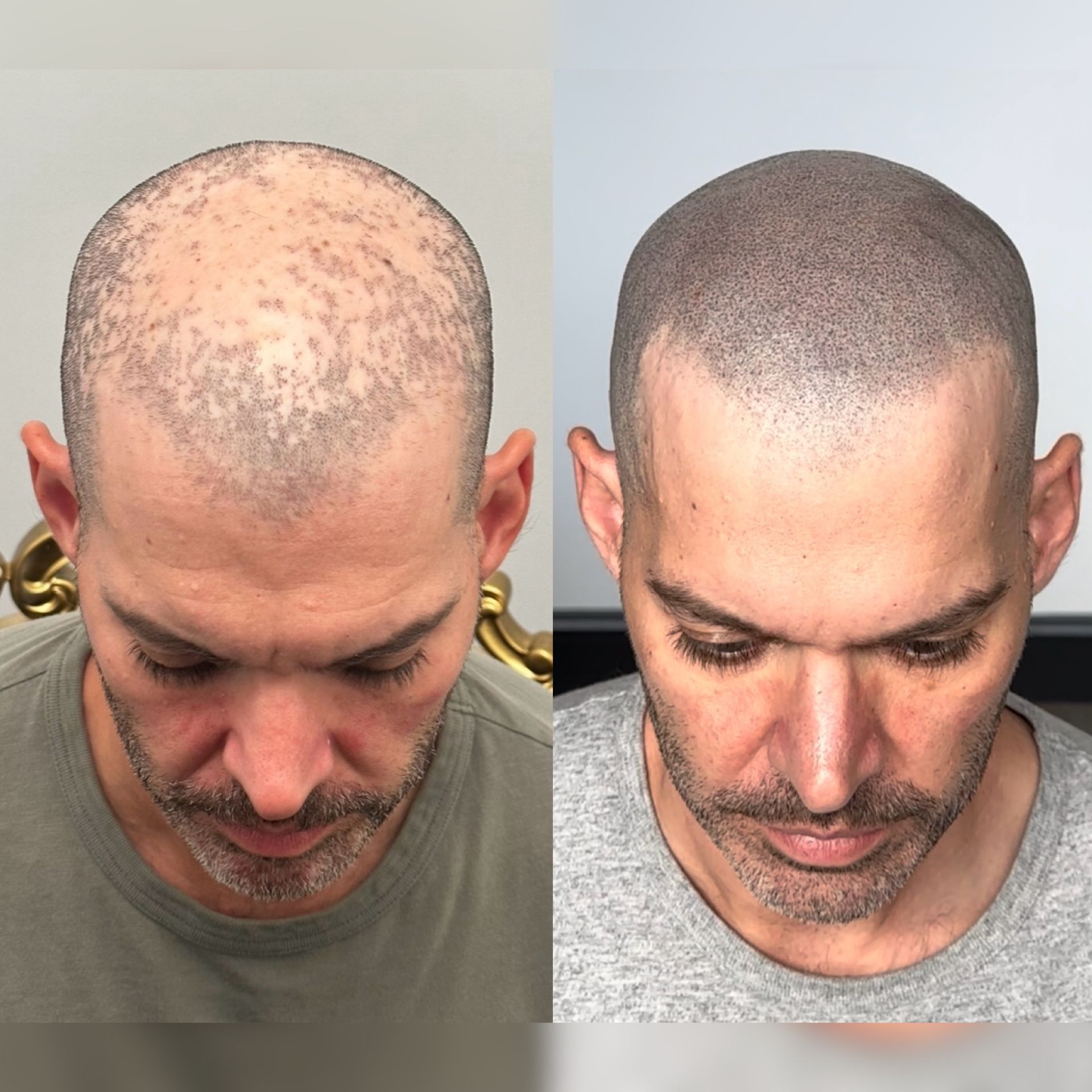 Before and after scalp micropigmentation on a man. Scalp appearance changes from patchy to dense with shaved head.