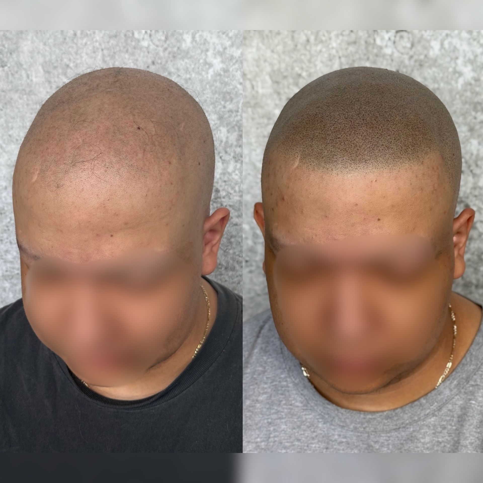 Before and after scalp micropigmentation. Bald head with sparse dots added to create a fuller appearance.