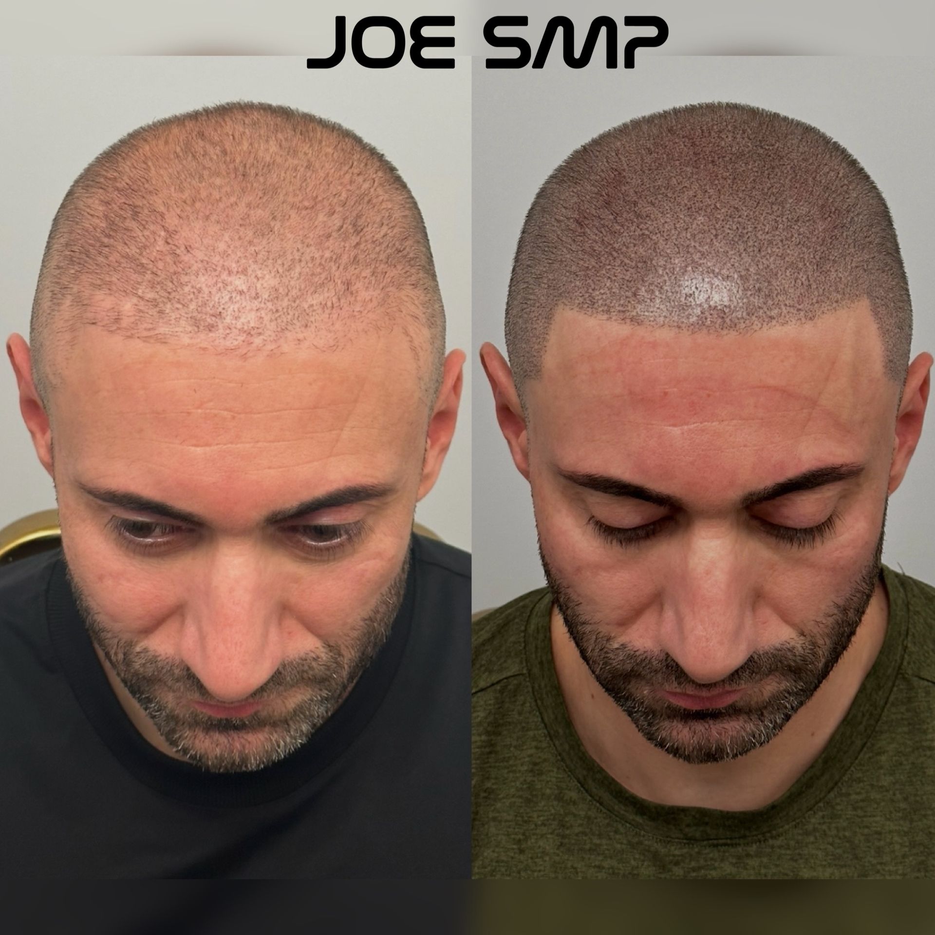 Comparison of a man's head before and after Scalp Micropigmentation (SMP) treatment; showing a fuller hairline.