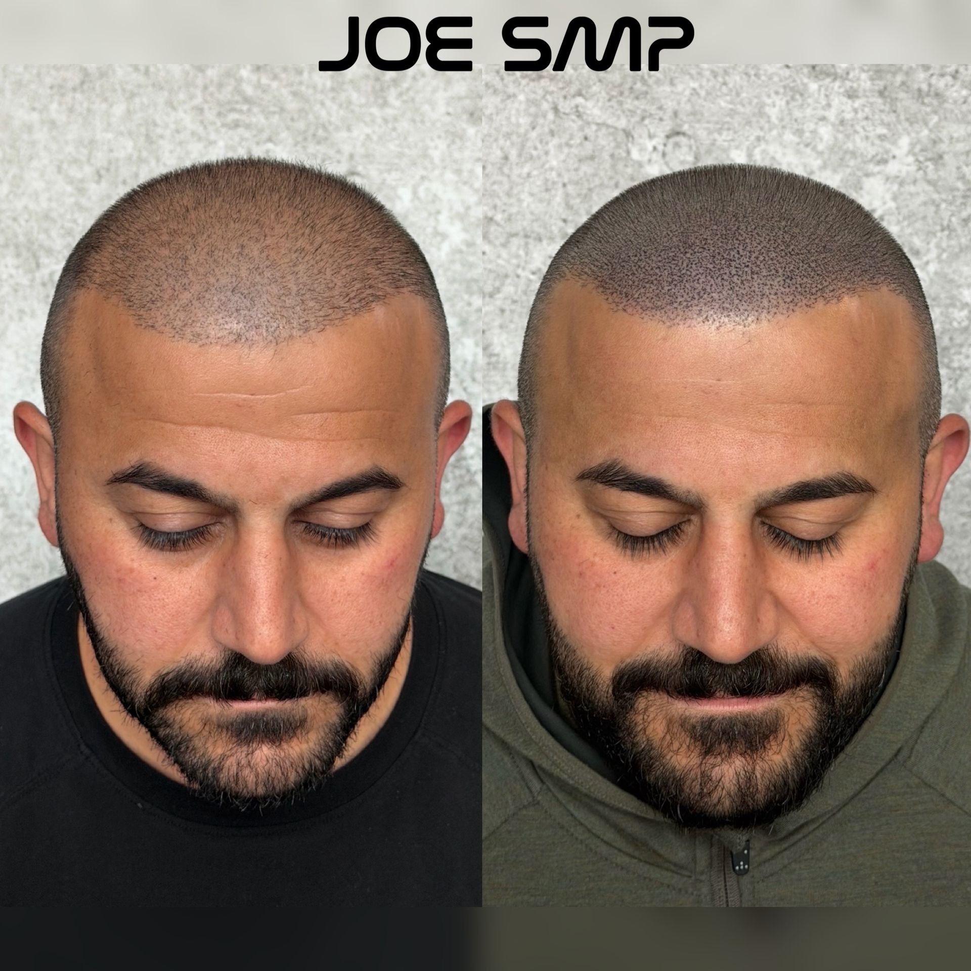 Before and after Scalp Micropigmentation treatment on a man; results show the appearance of hair.