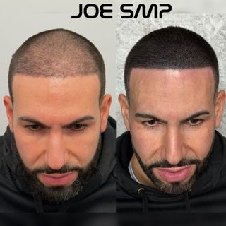 Side-by-side comparison of a man's head before and after Scalp Micropigmentation (SMP) treatment, showing a denser hairline.